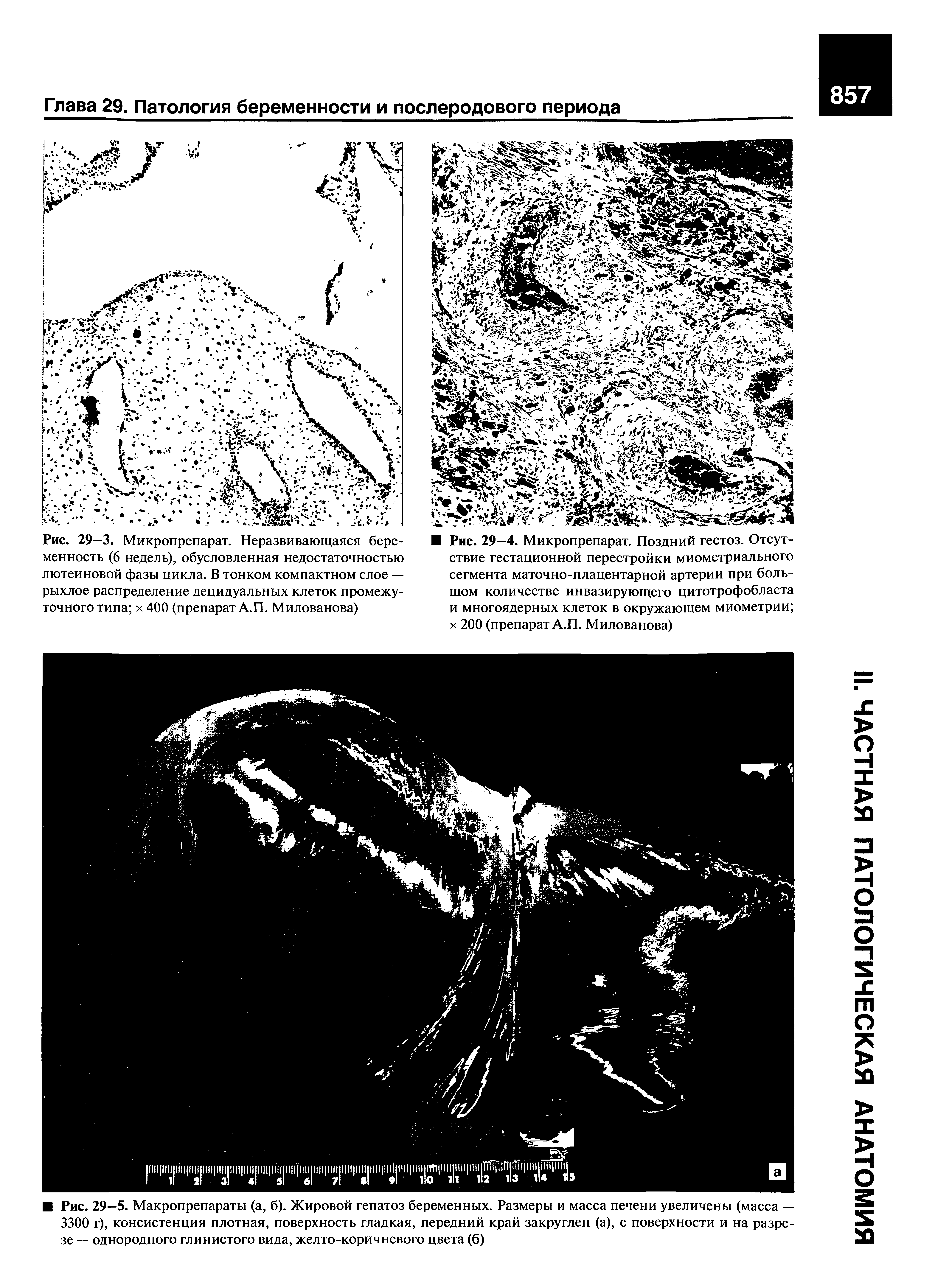 Рис. 29—3. Микропрепарат. Неразвивающаяся беременность (6 недель), обусловленная недостаточностью лютеиновой фазы цикла. В тонком компактном слое — рыхлое распределение децидуальных клеток промежуточного типа х 400 (препарат А.П. Милованова)...