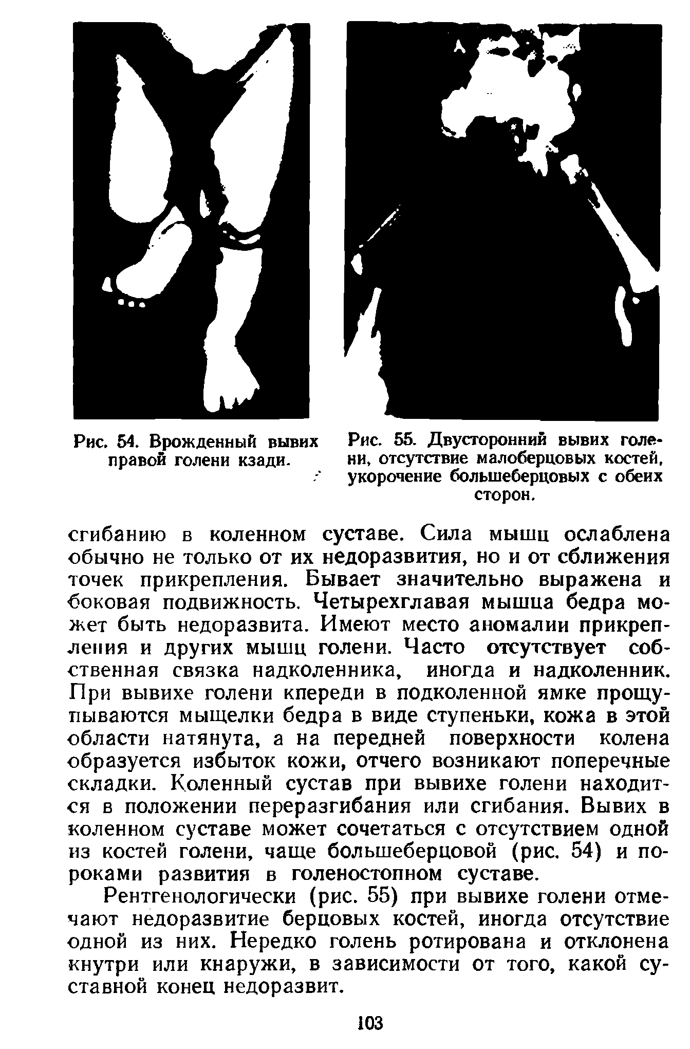 Рис. 55. Двусторонний вывих голени, отсутствие малоберцовых костей, укорочение большеберцовых с обеих сторон.