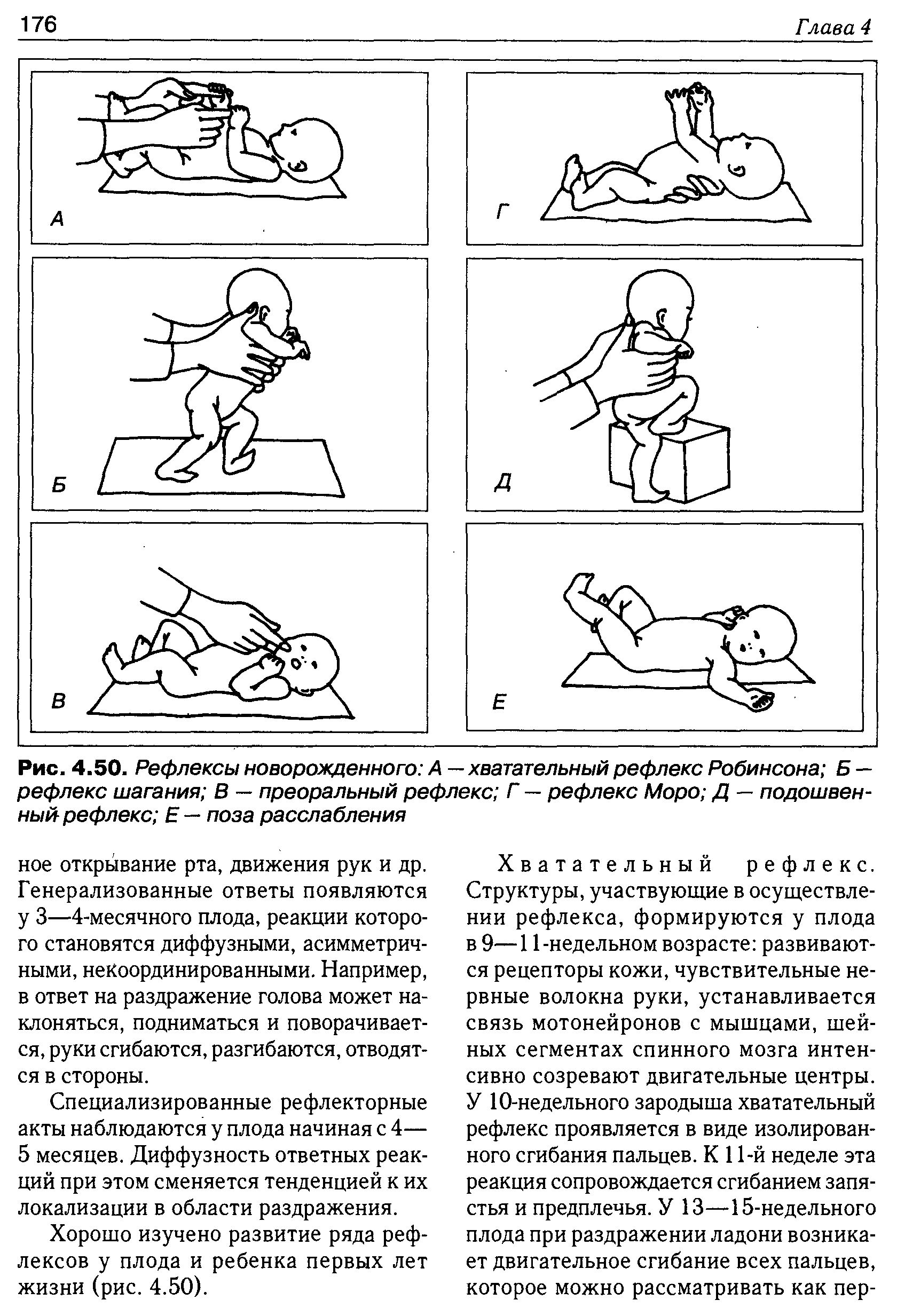 Рис. 4.50. Рефлексы новорожденного А — хватательный рефлекс Робинсона Б — рефлекс шагания В — преоральный рефлекс Г — рефлекс Моро Д — подошвенный рефлекс Е — поза расслабления...