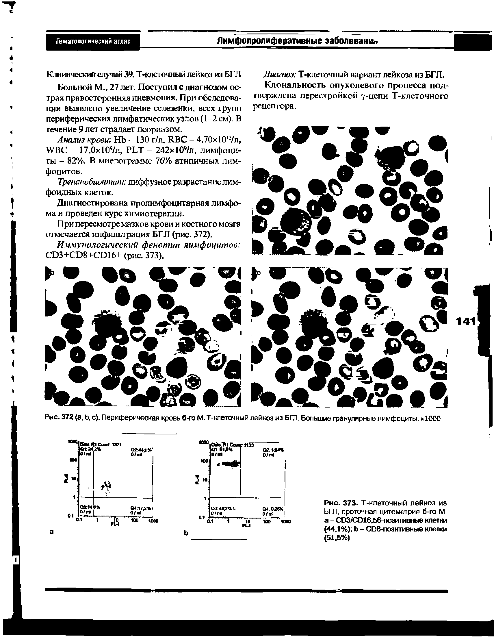 Рис. 373. Т-клеточный лейкоз из БГЛ, проточная цитометрия б-го М а - СОЗ/СО16,56-позитивные клетки (44.1%) Ь - СО8-поэитмвные клетки (51,5%)...