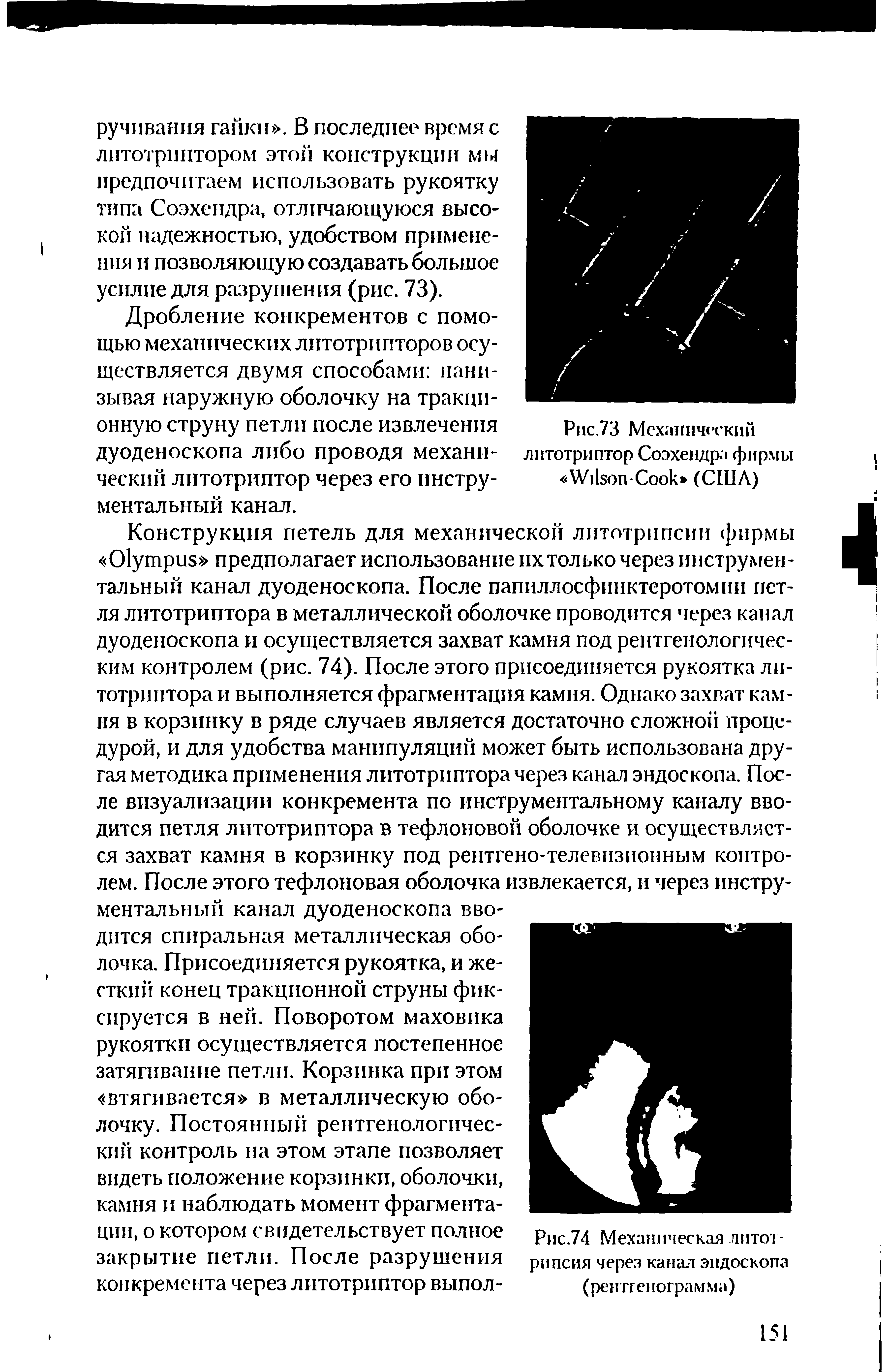 Рис.74 Механическая литотрипсия через канал эндоскопа (рентгенограмма)...