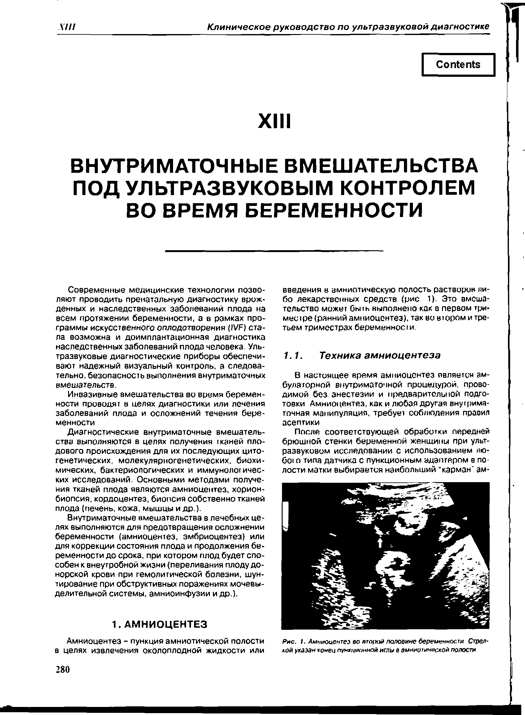 Рис. 1. Амниоцентез во второй половине беременности Стрелкой указа гонец пуниционмой иглы в амниотической полости...