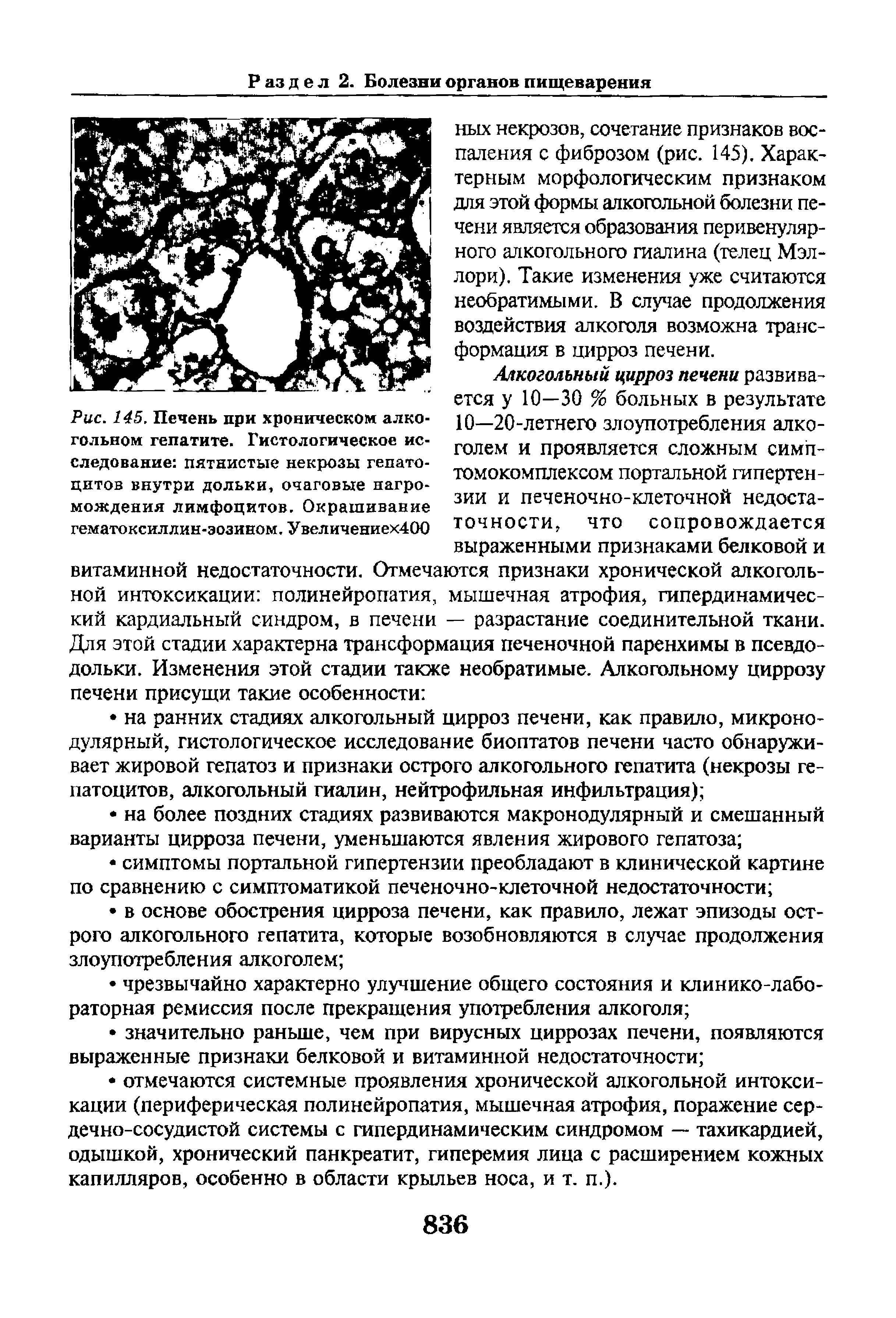 Рис. 145. Печень при хроническом алкогольном гепатите. Гистологическое исследование пятнистые некрозы гепатоцитов внутри дольки, очаговые нагромождения лимфоцитов. Окрашивание гематоксиллин-эозином. Увеличениех400...