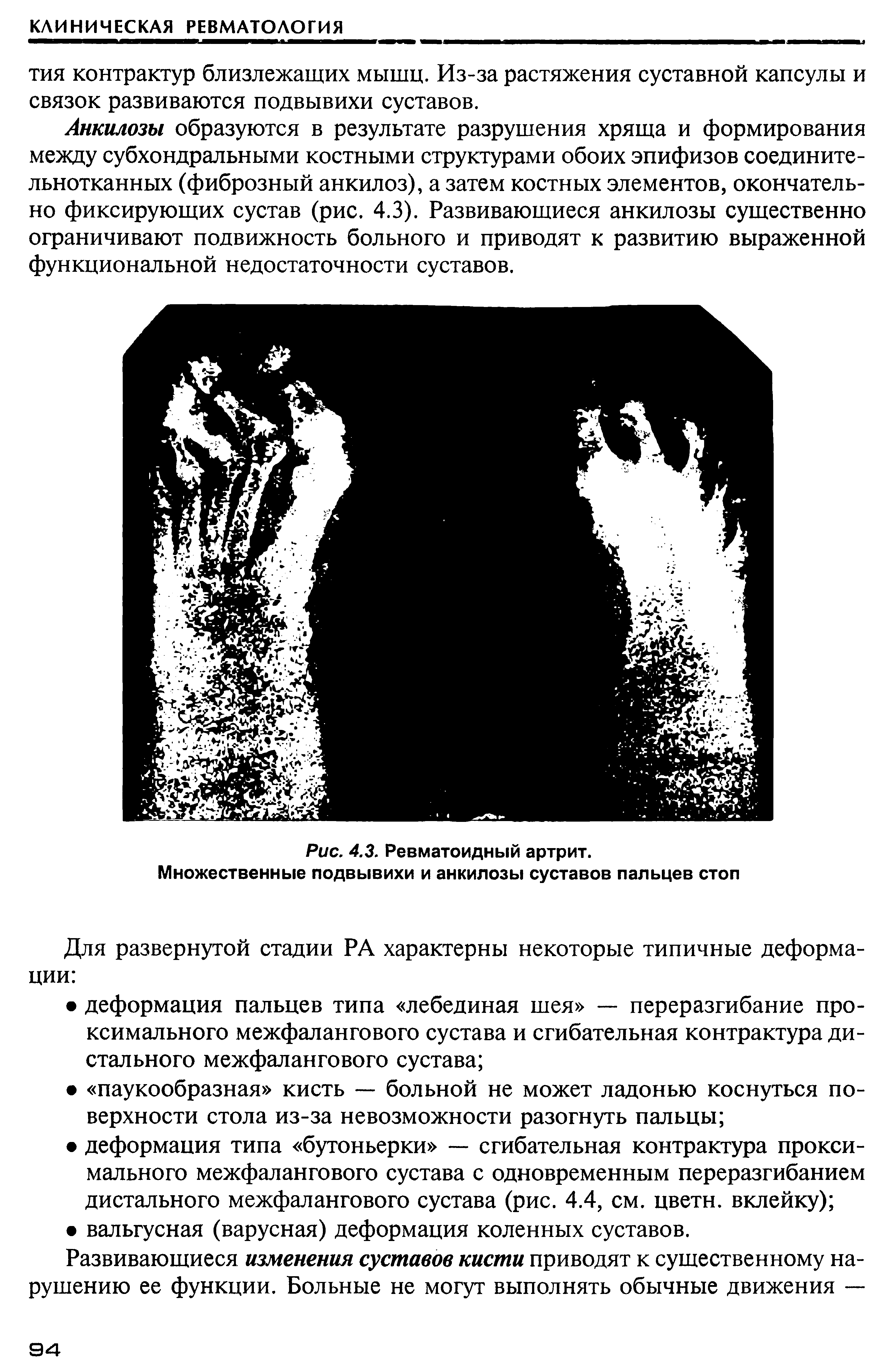 Рис. 4.3. Ревматоидный артрит. Множественные подвывихи и анкилозы суставов пальцев стоп...