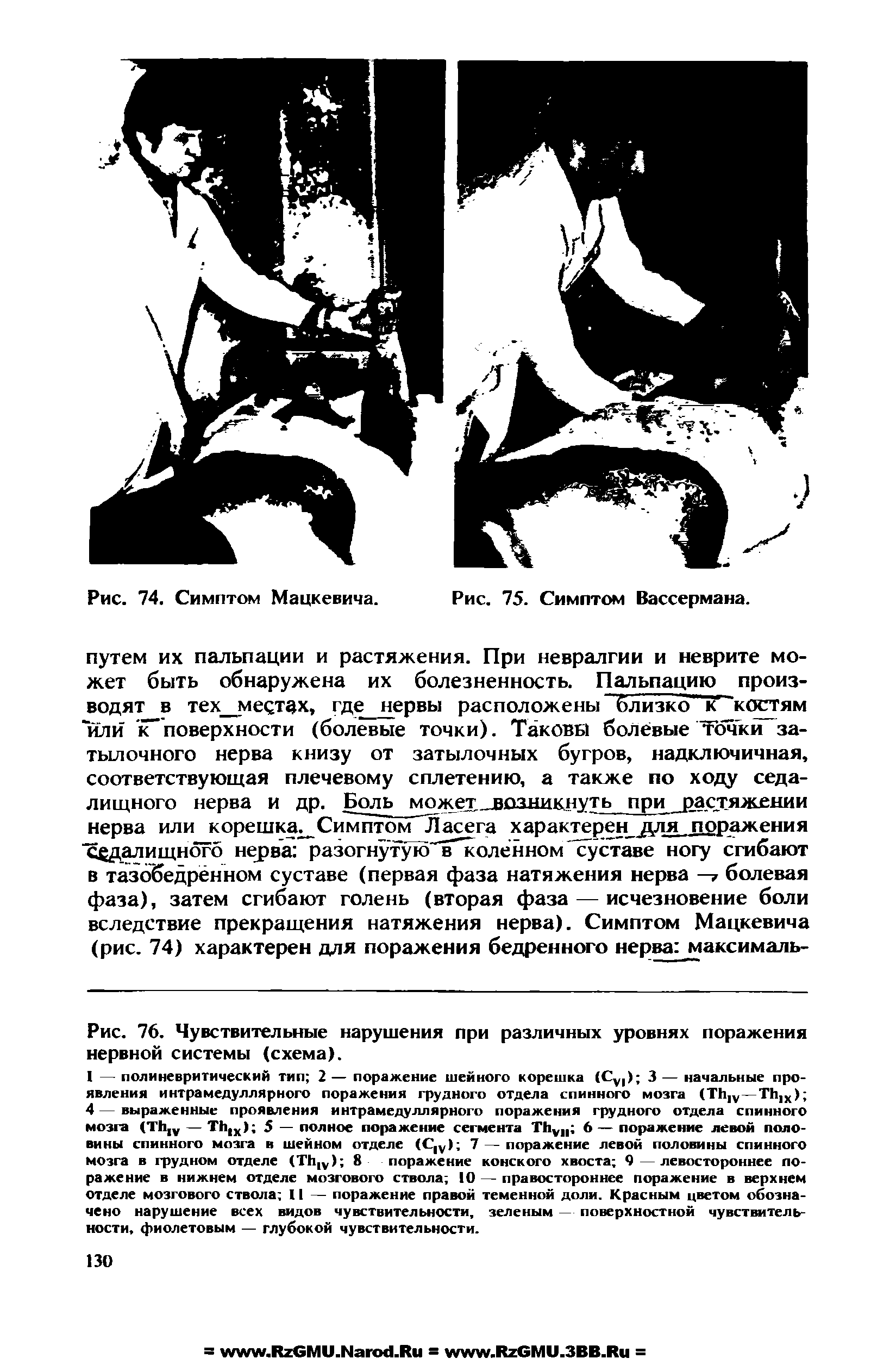 Рис. 76. Чувствительные нарушения при различных уровнях поражения нервной системы (схема).