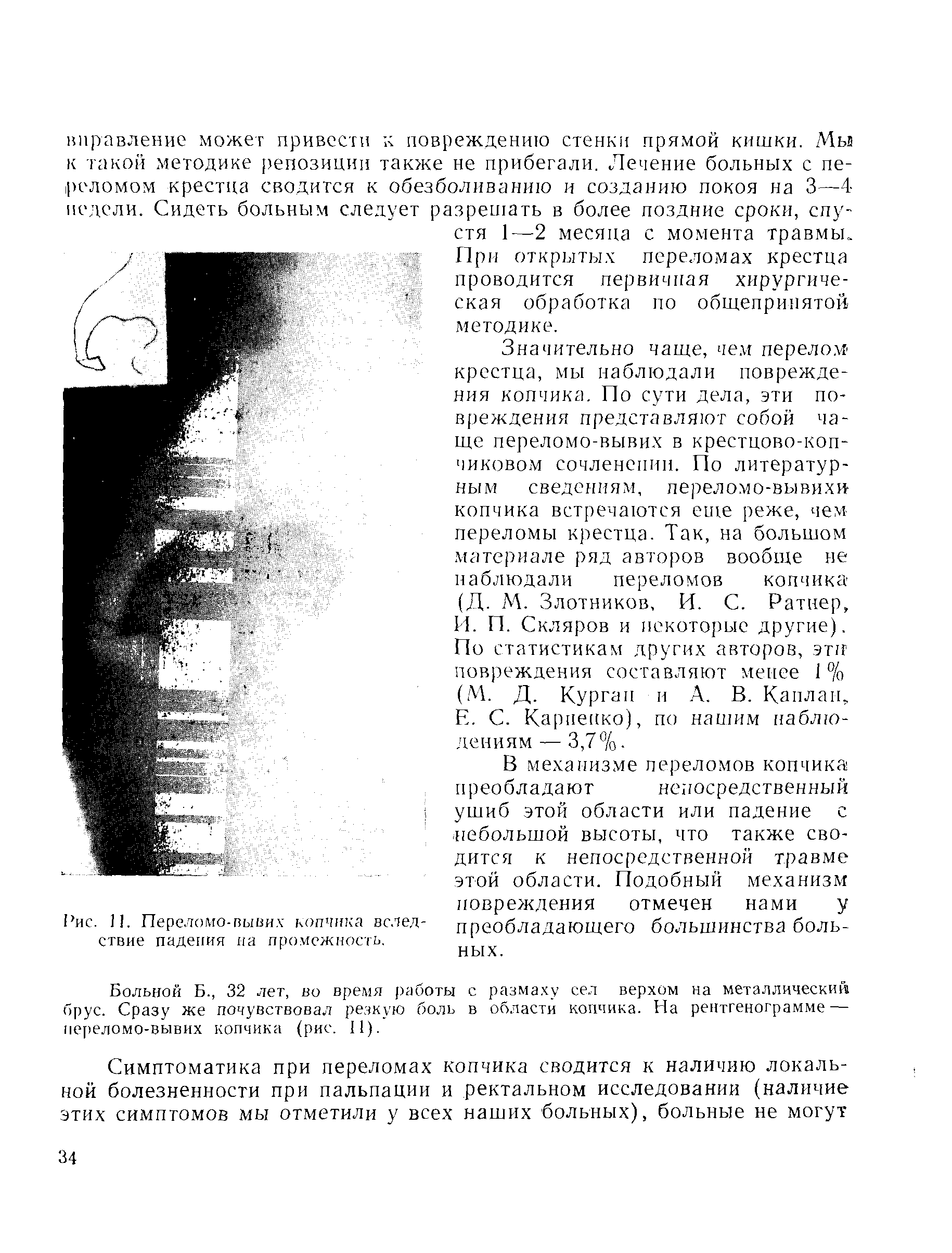 Рис. 11. Переломе-вывих копчика вследствие падения на промежность.