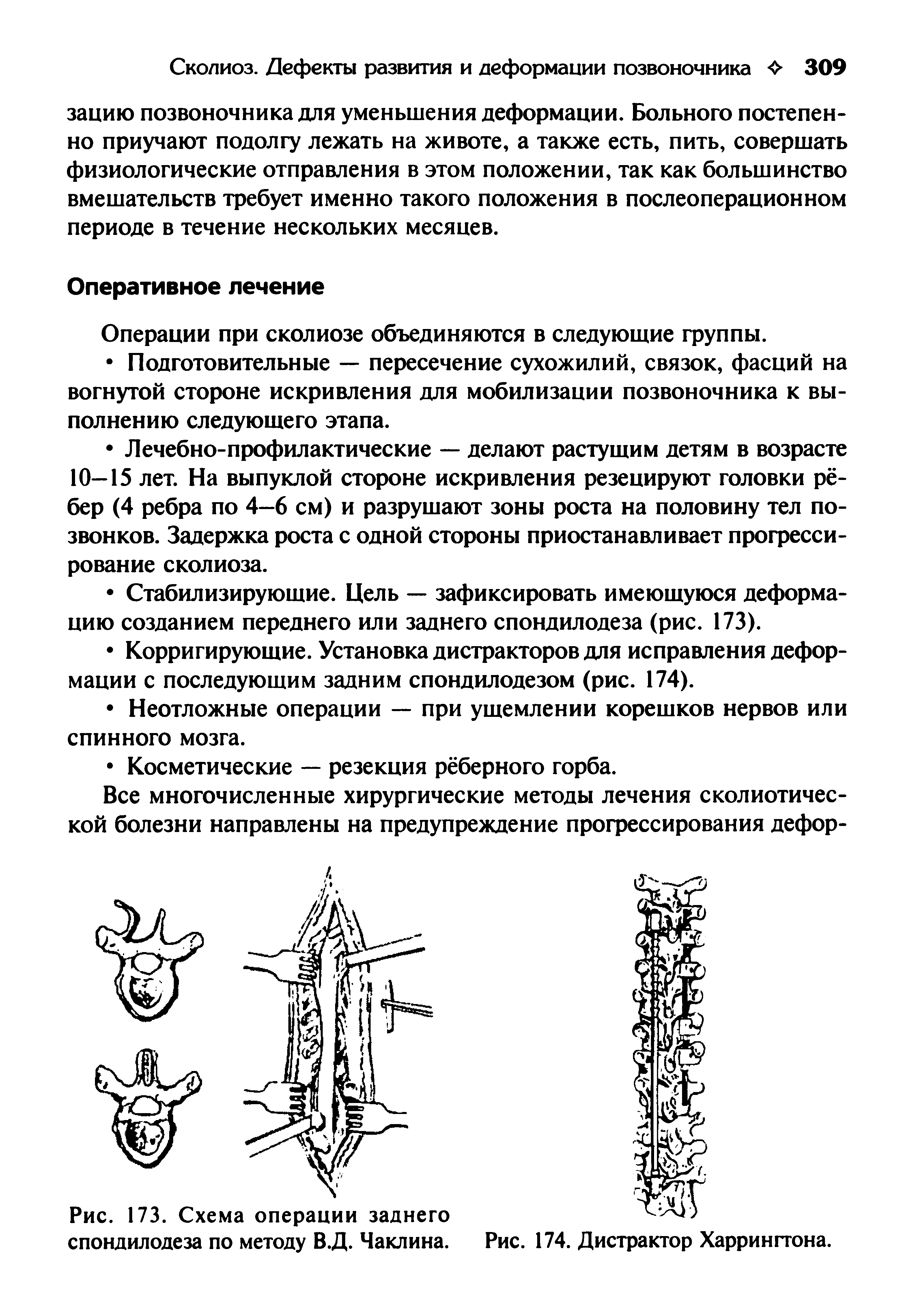 Рис. 173. Схема операции заднего спондилодеза по методу В.Д. Чаклина.