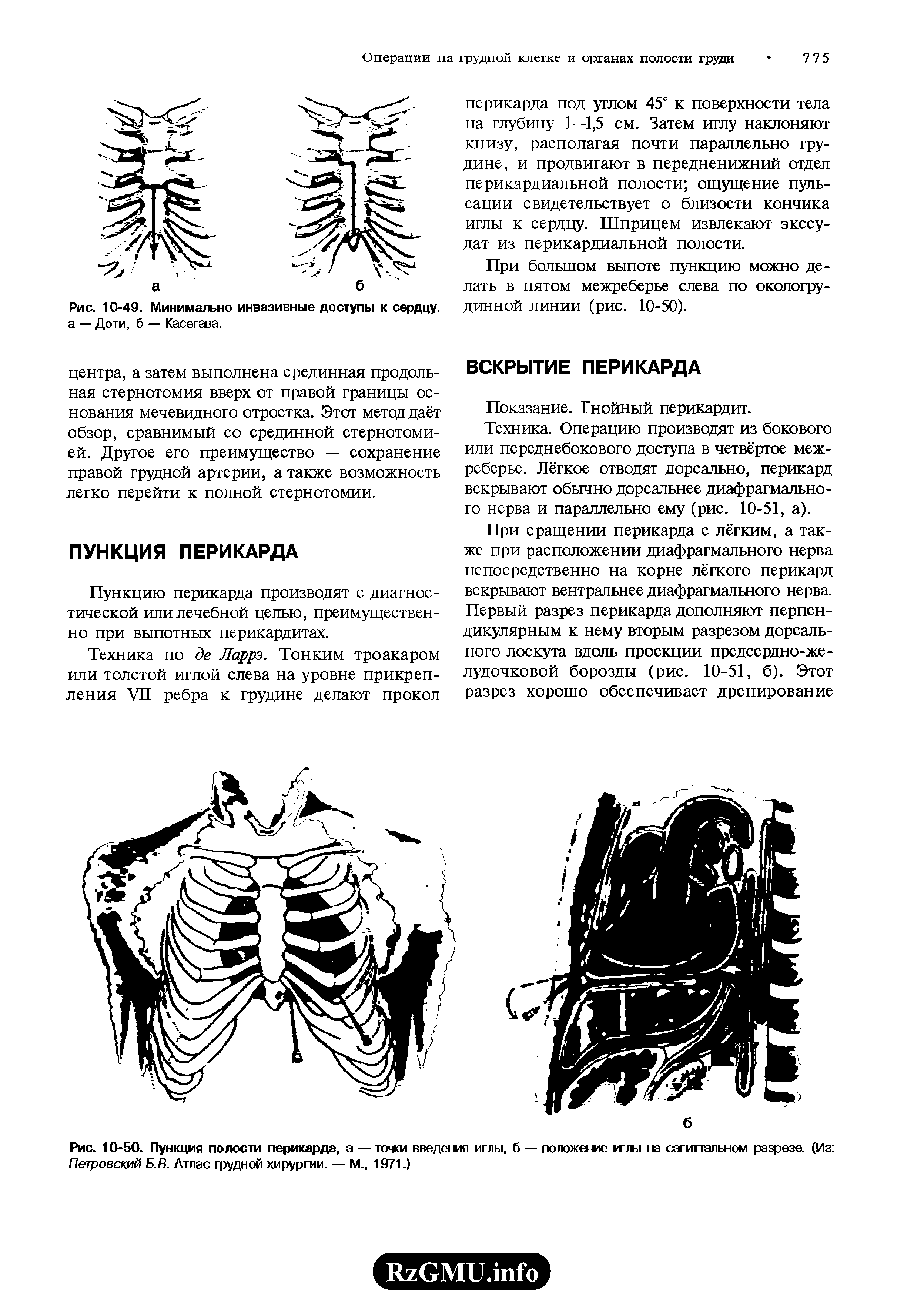 Рис. 10-50. Пункция полости перикарда, а — точки введения иглы, б — положение иглы на сагиттальном разрезе. (Из Петровский Б.В. Атлас грудной хирургии. — М., 1971.)...