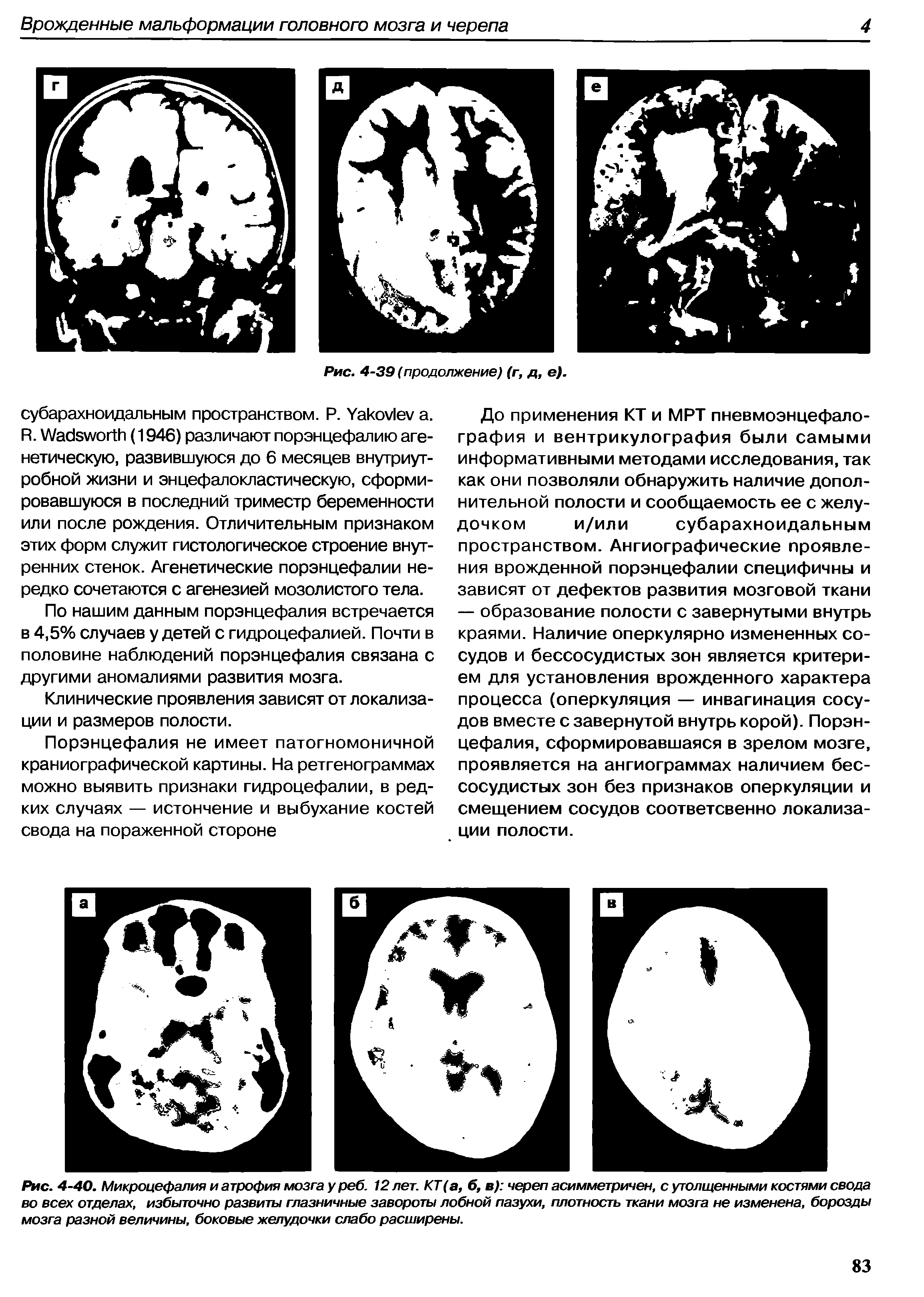 Рис. 4-40. Микроцефалия и атрофия мозга у реб. 12 лет. КТ(а, б, в) череп асимметричен, с утолщенными костями свода во всех отделах, избыточно развиты глазничные завороты лобной пазухи, плотность ткани мозга не изменена, борозды мозга разной величины, боковые желудочки слабо расширены.