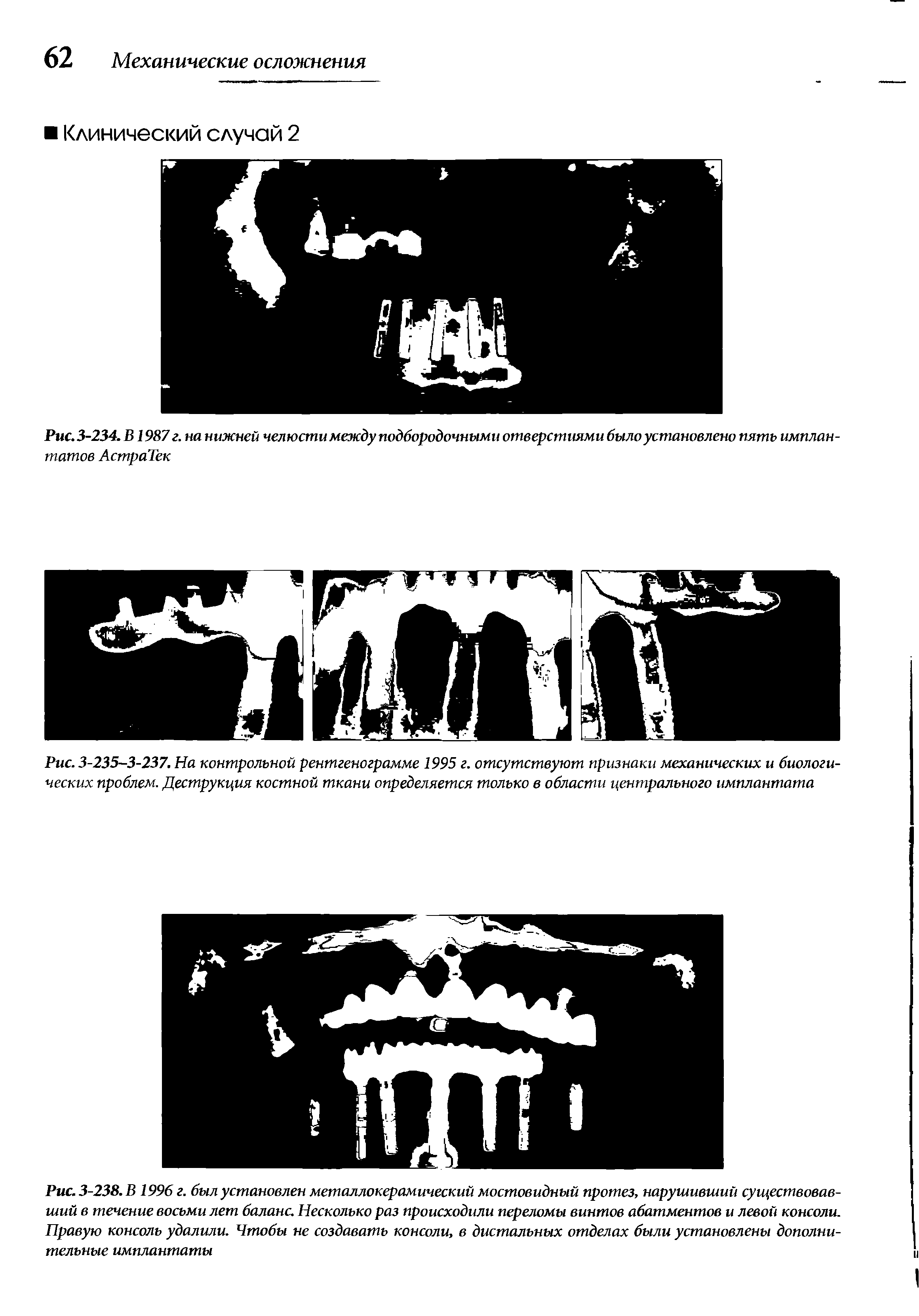 Рис. 3-238. В 1996 г. был установлен металлокерамический мостовидный протез, нарушивший существовавший в течение восьми лет баланс. Несколько раз происходили переломы винтов абатментов и левой консоли. Правую консоль удалили. Чтобы не создавать консоли, в дистальных отделах были установлены дополнительные имплантаты...