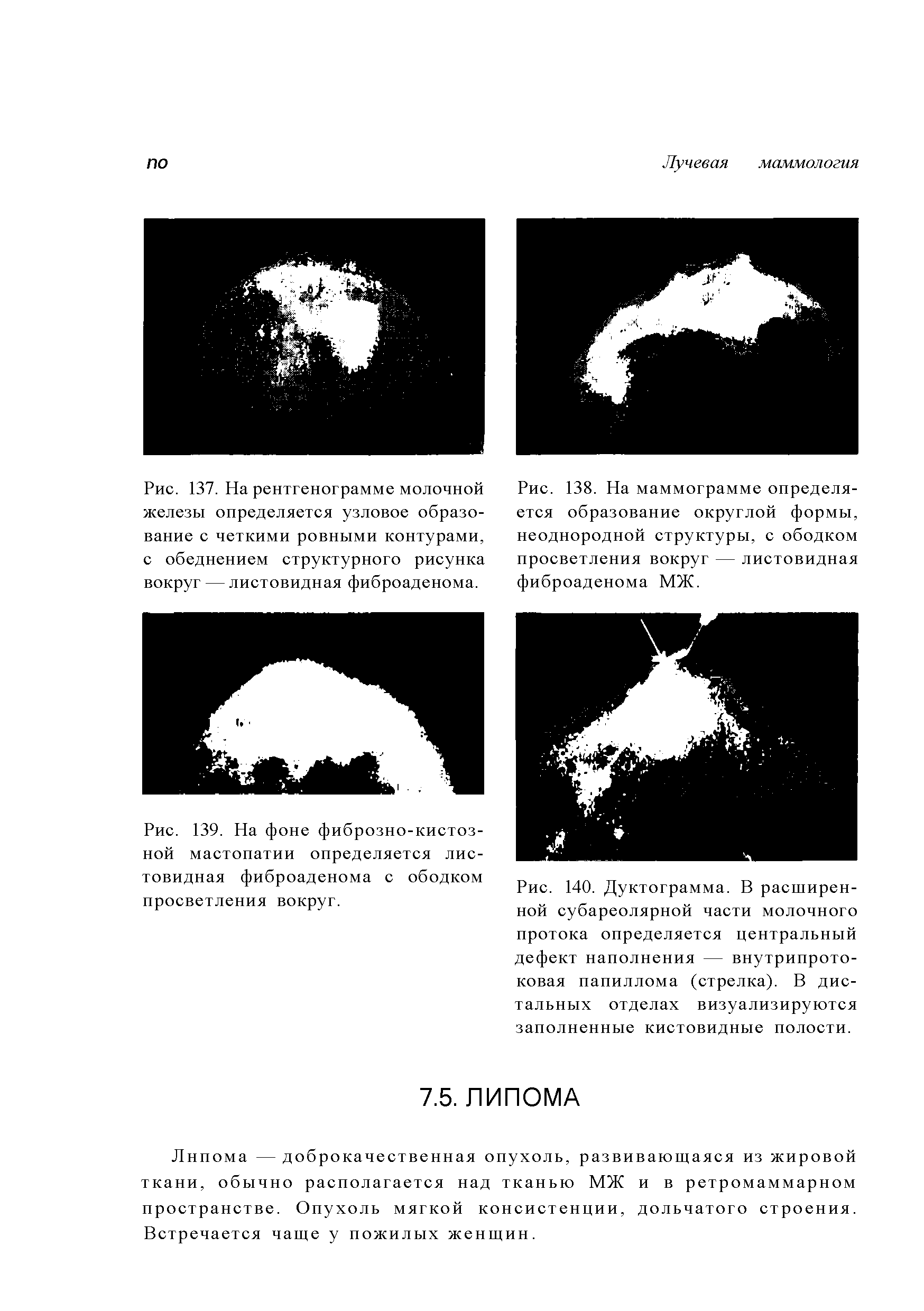 Рис. 137. На рентгенограмме молочной железы определяется узловое образование с четкими ровными контурами, с обеднением структурного рисунка вокруг — листовидная фиброаденома.