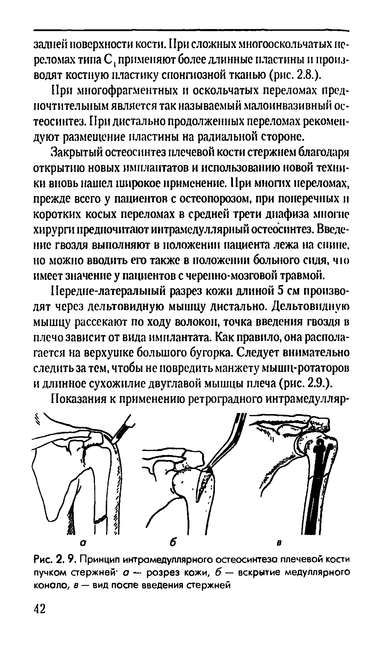 Рис. 2. 9. Принцип интрамедуллярного остеосинтеза плечевой кости пучком стержней а — розрез кожи, б — вскрытие медуллярного конало, в — вид поспе введения стержней...