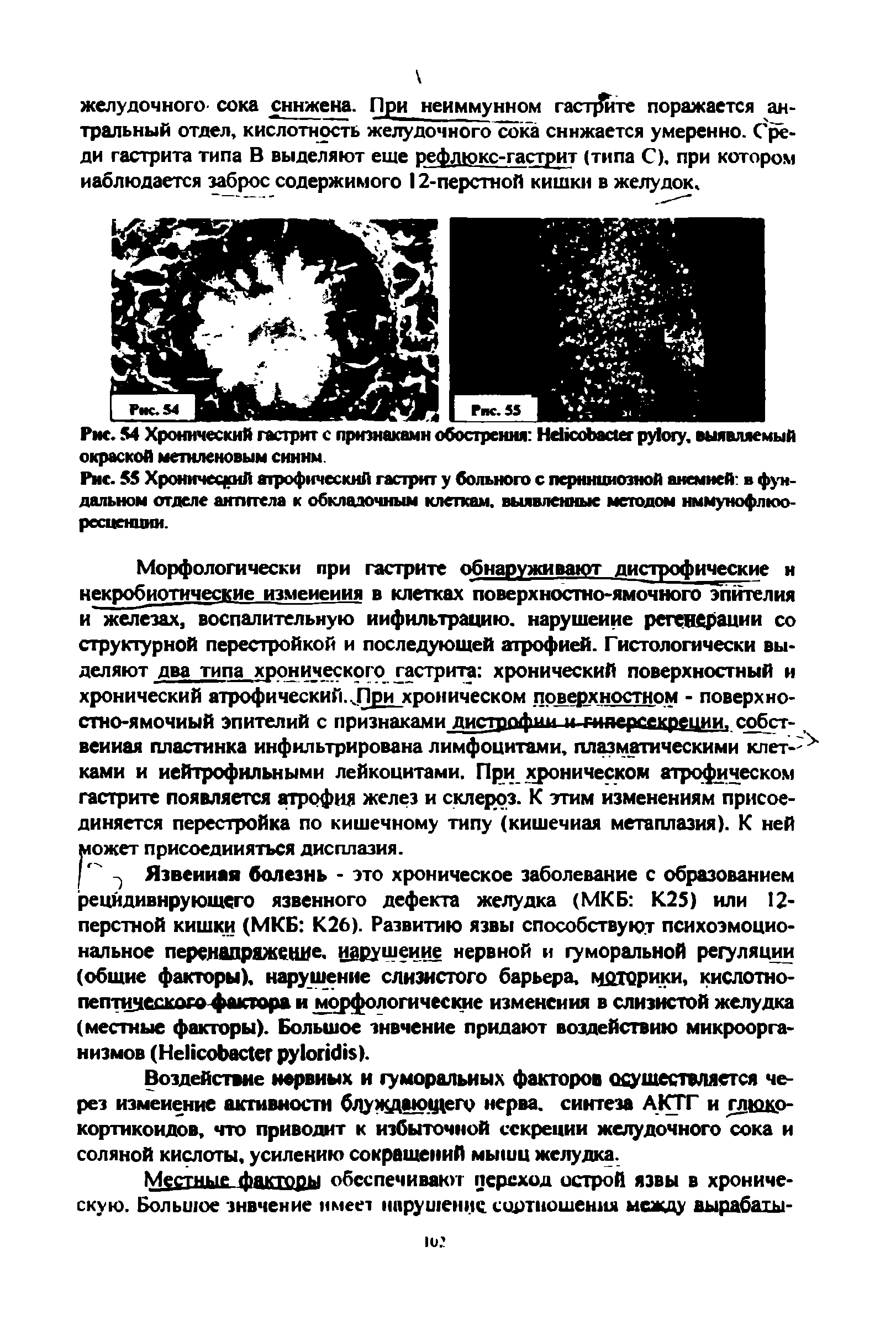 Рис. 55 Хронический атрофический гастрит у больного с пернициозной анемией в фундальном отделе аиппела к обкладочным клеткам, выявленные методом нммунофлюо-ресценции.