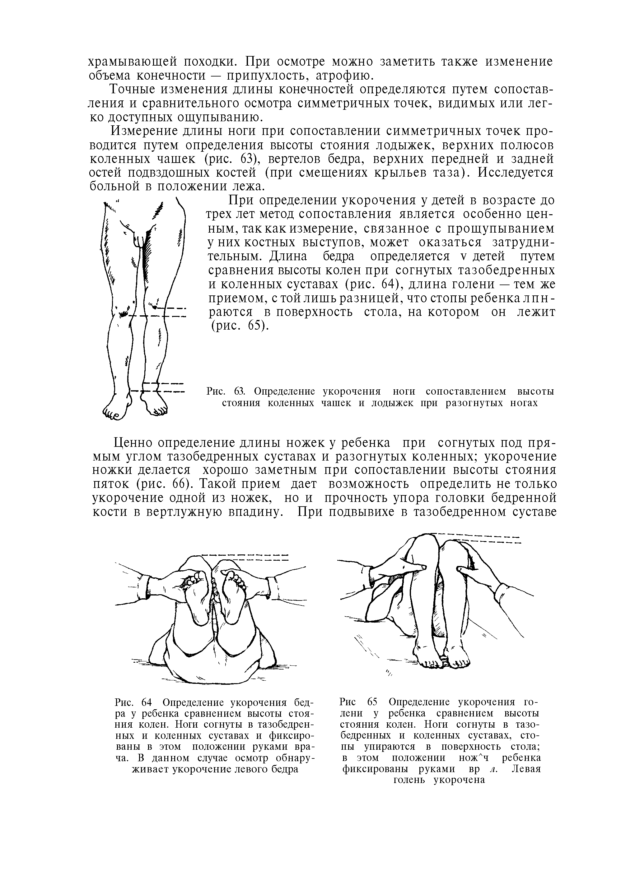 Рис. 64 Определение укорочения бедра у ребенка сравнением высоты стояния колен. Ноги согнуты в тазобедренных и коленных суставах и фиксированы в этом положении руками врача. В данном случае осмотр обнаруживает укорочение левого бедра...