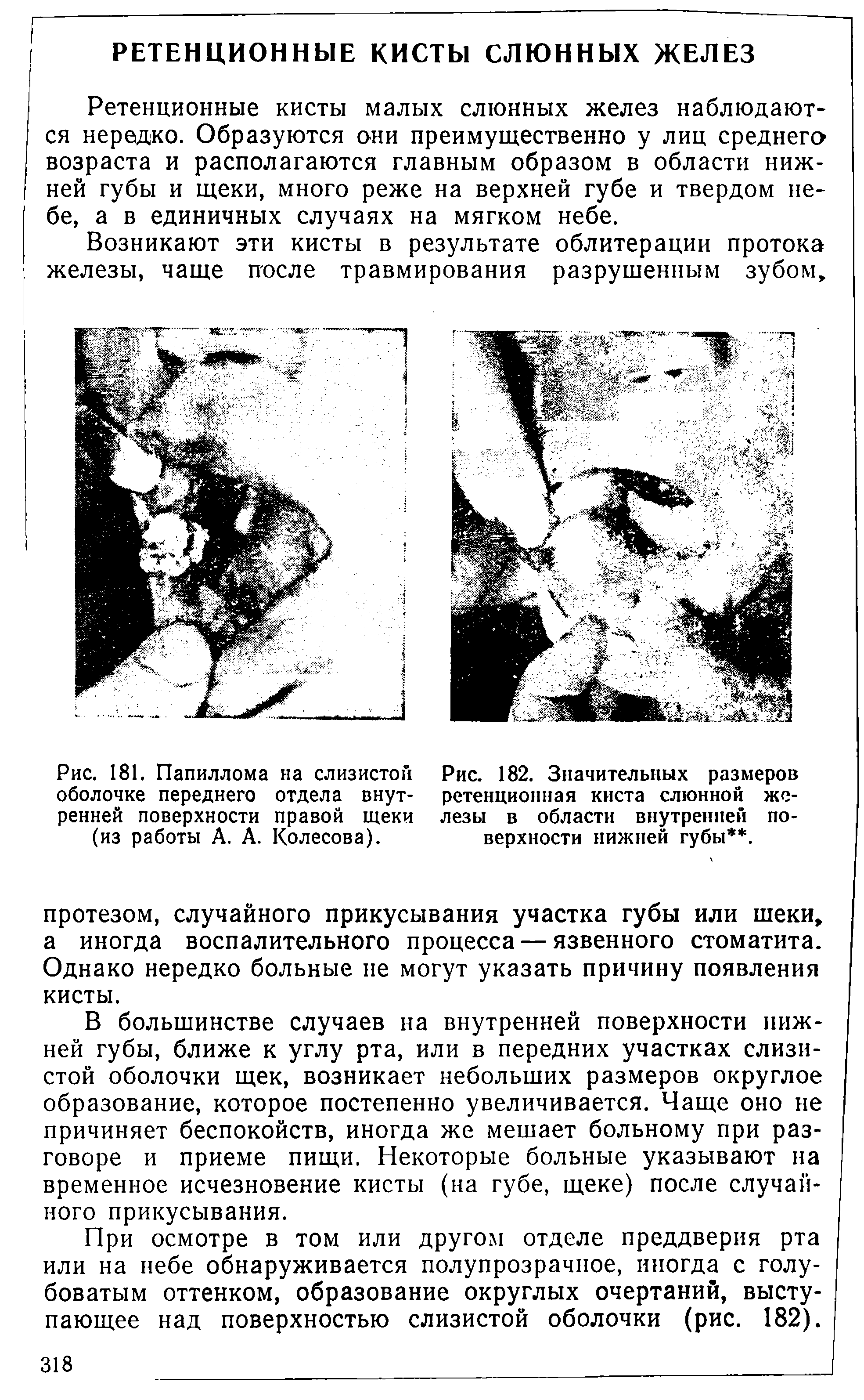 Рис. 182. Значительных размеров ретенционная киста слюнной железы в области внутренней поверхности нижней губы. ...