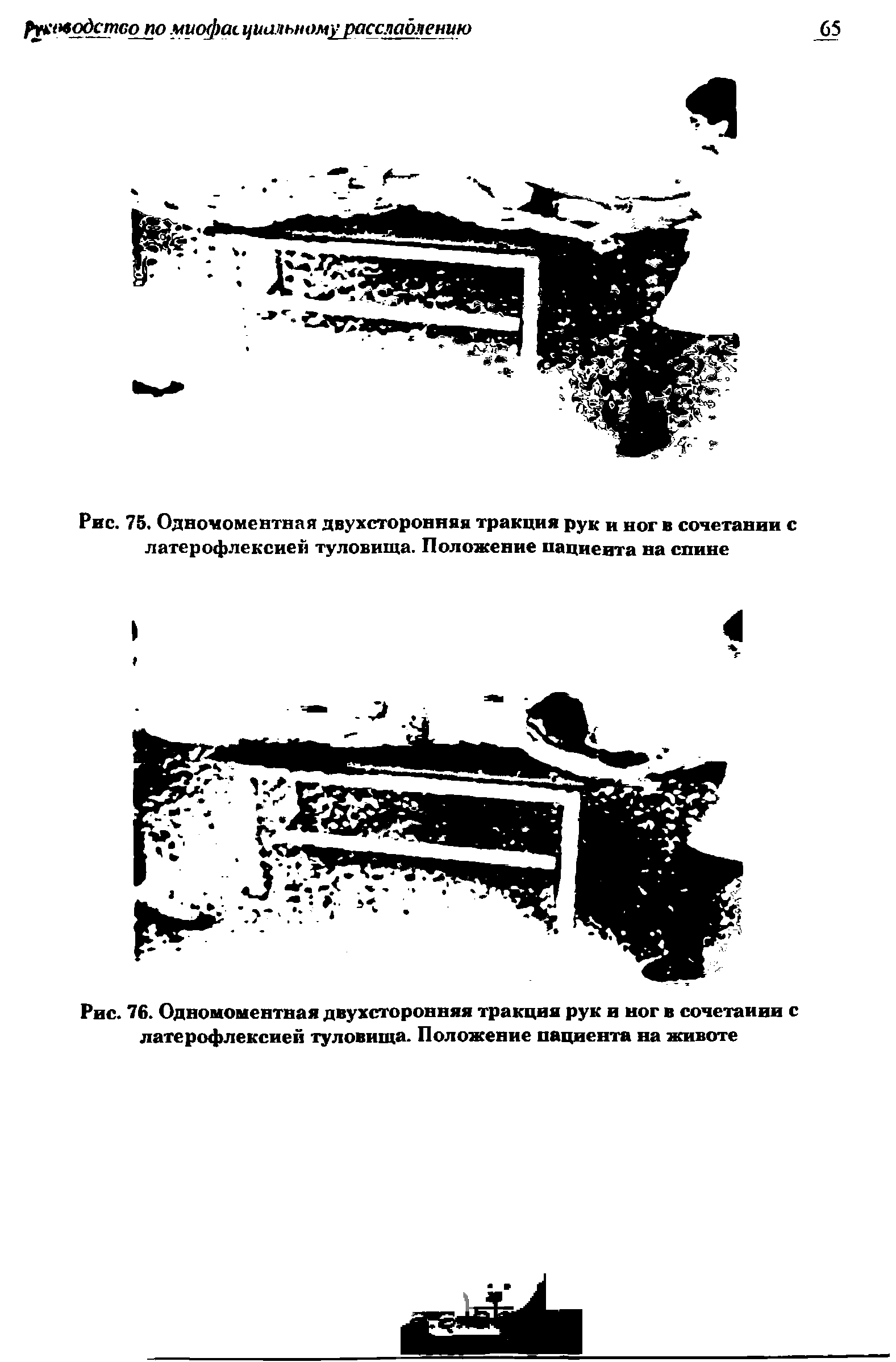 Рис. 76. Одномоментная двухсторонняя тракция рук и ног в сочетании с латерофлексией туловища. Положение пациента на животе...