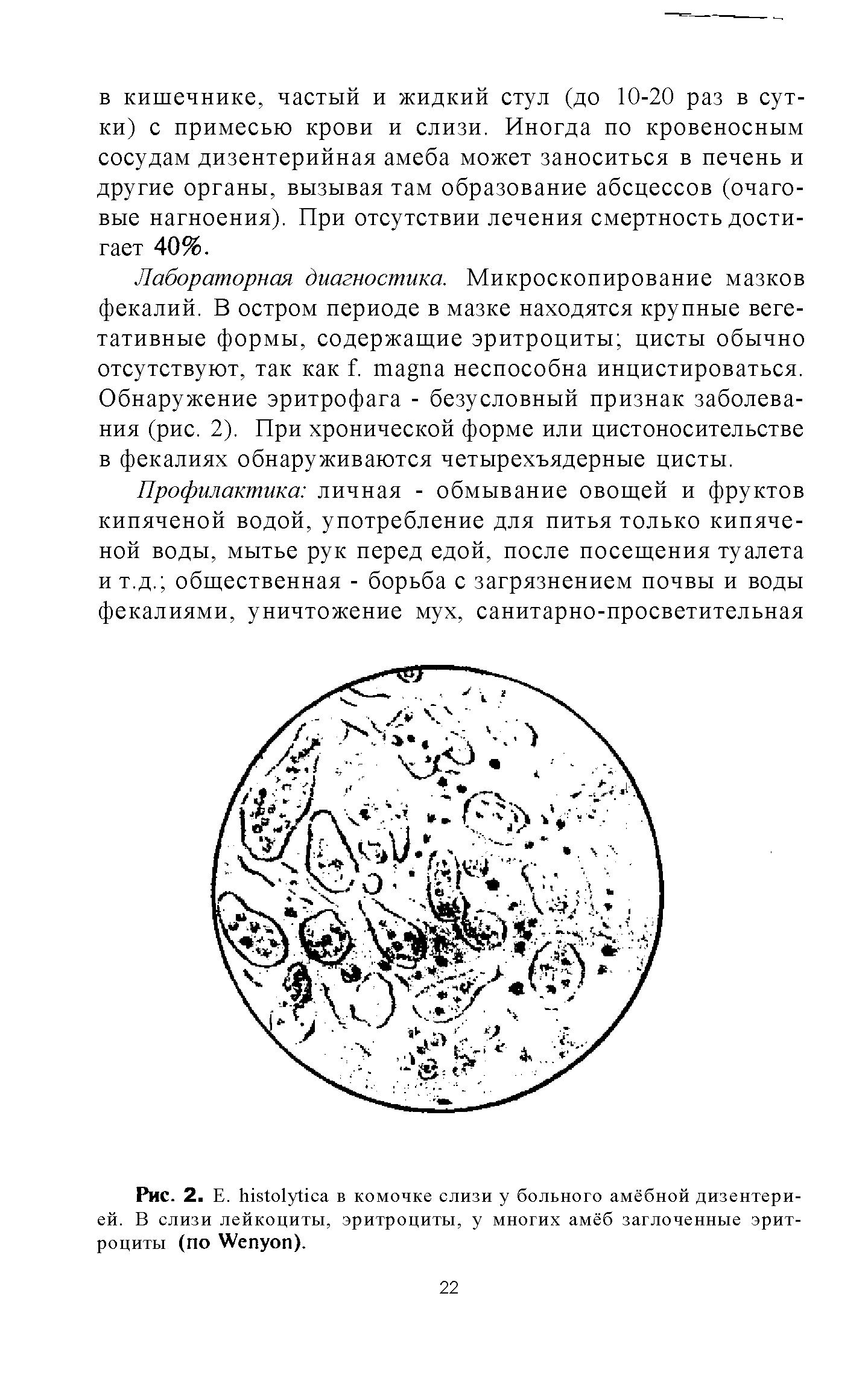 Рис. 2. Е. в комочке слизи у больного амёбной дизентерией. В слизи лейкоциты, эритроциты, у многих амёб заглоченные эритроциты (по W ).