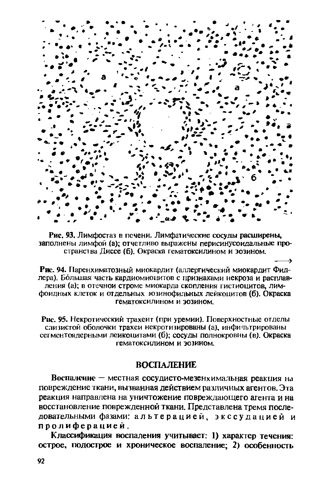 Рис. 94. Паренхиматозный миокардит (аллергический миокардит Фидлера). Большая часть кардиомиоцитов с признаками некроза и расплавления (а) в отечной строме миокарда скопления гистиоцитов, лимфоидных клеток и отдельных эозинофильных лейкоцитов (б). Окраска гематоксилином и эозином.