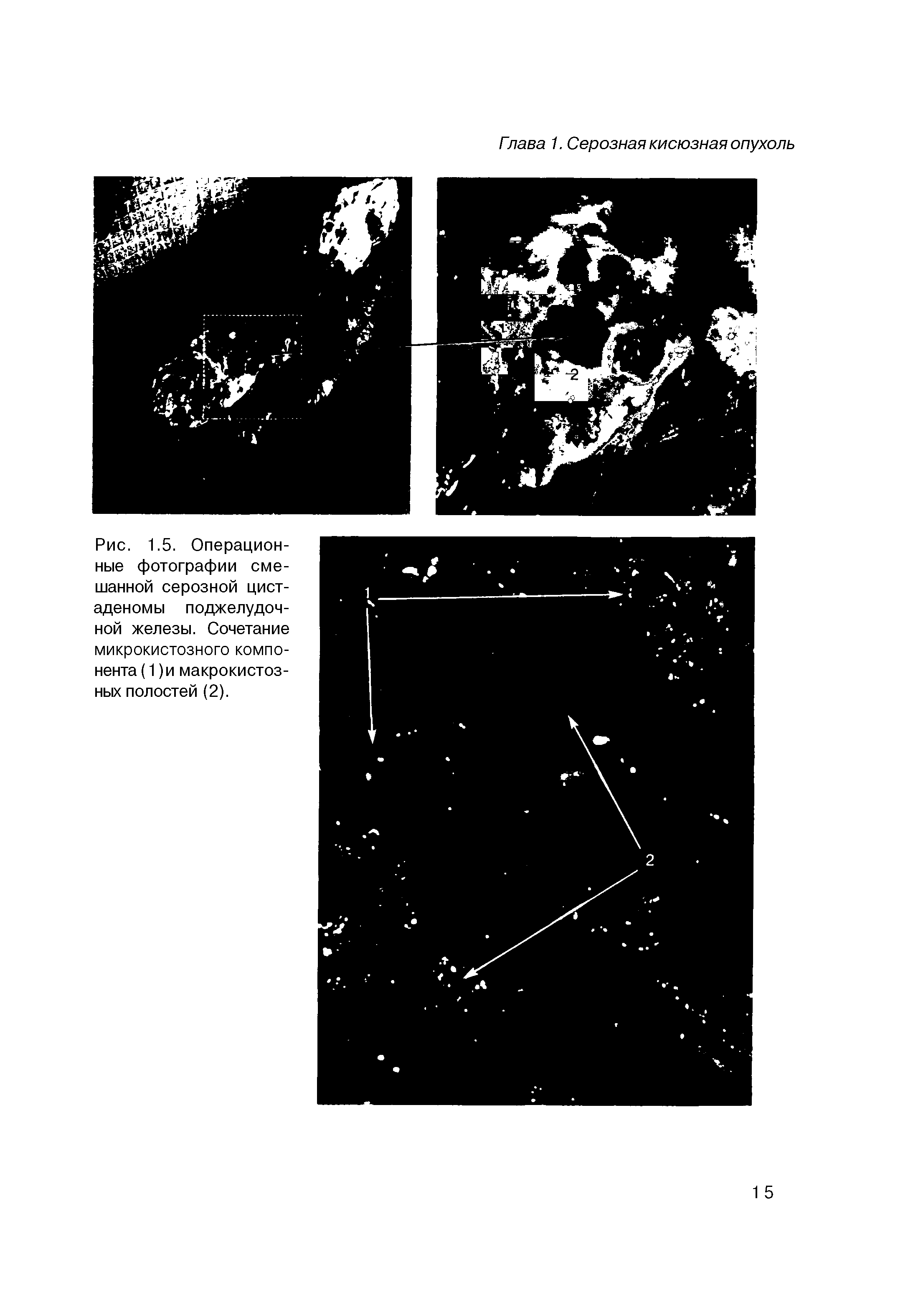 Рис. 1.5. Операционные фотографии смешанной серозной цист-аденомы поджелудочной железы. Сочетание микрокистозного компонента (1)и макрокистоз-ных полостей (2).