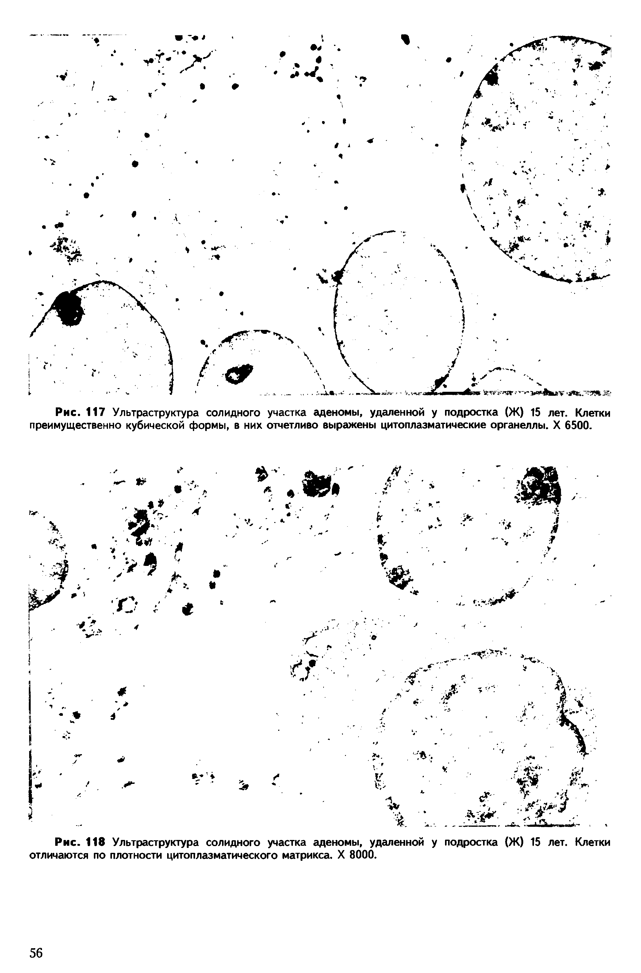 Рис. 118 Ультраструктура солидного участка аденомы, удаленной у подростка (Ж) 15 лет. Клетки отличаются по плотности цитоплазматического матрикса. X 8000.