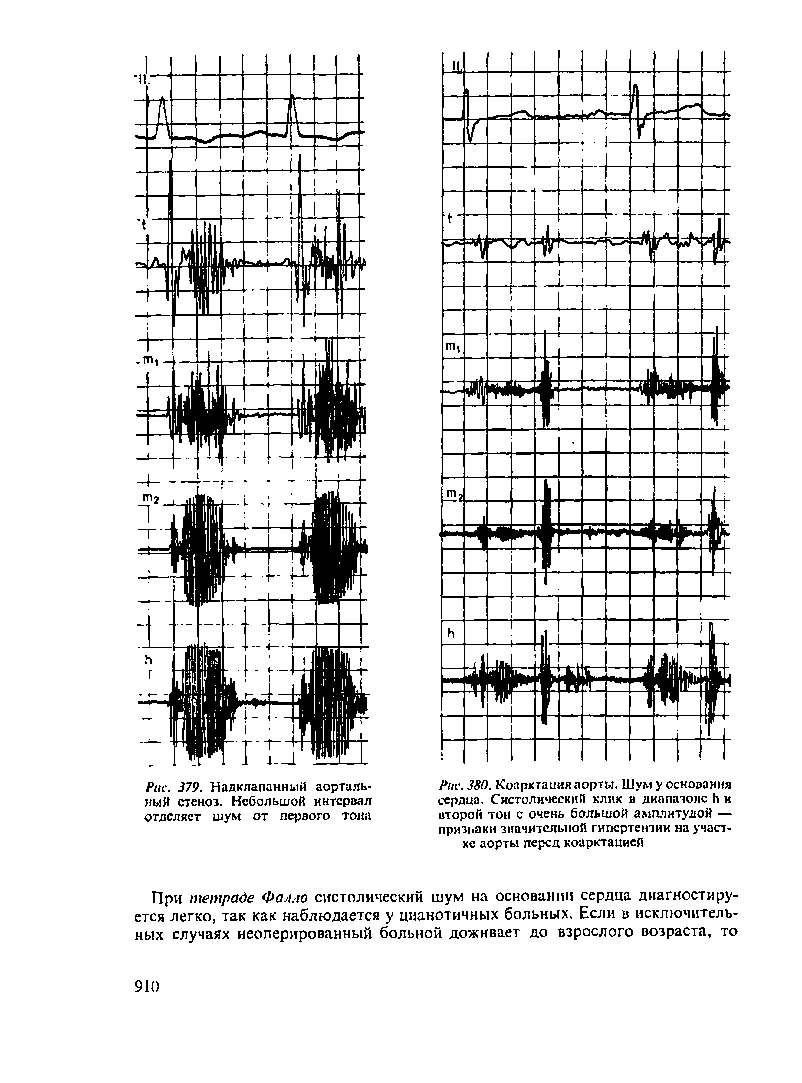 Рис. 380. Коарктация аорты. Шум у основания сердца. Систолический клик в диапазоне И и второй тон с очень большой амплитудой — признаки значительной гипертензии на участке аорты перед коарктацией...