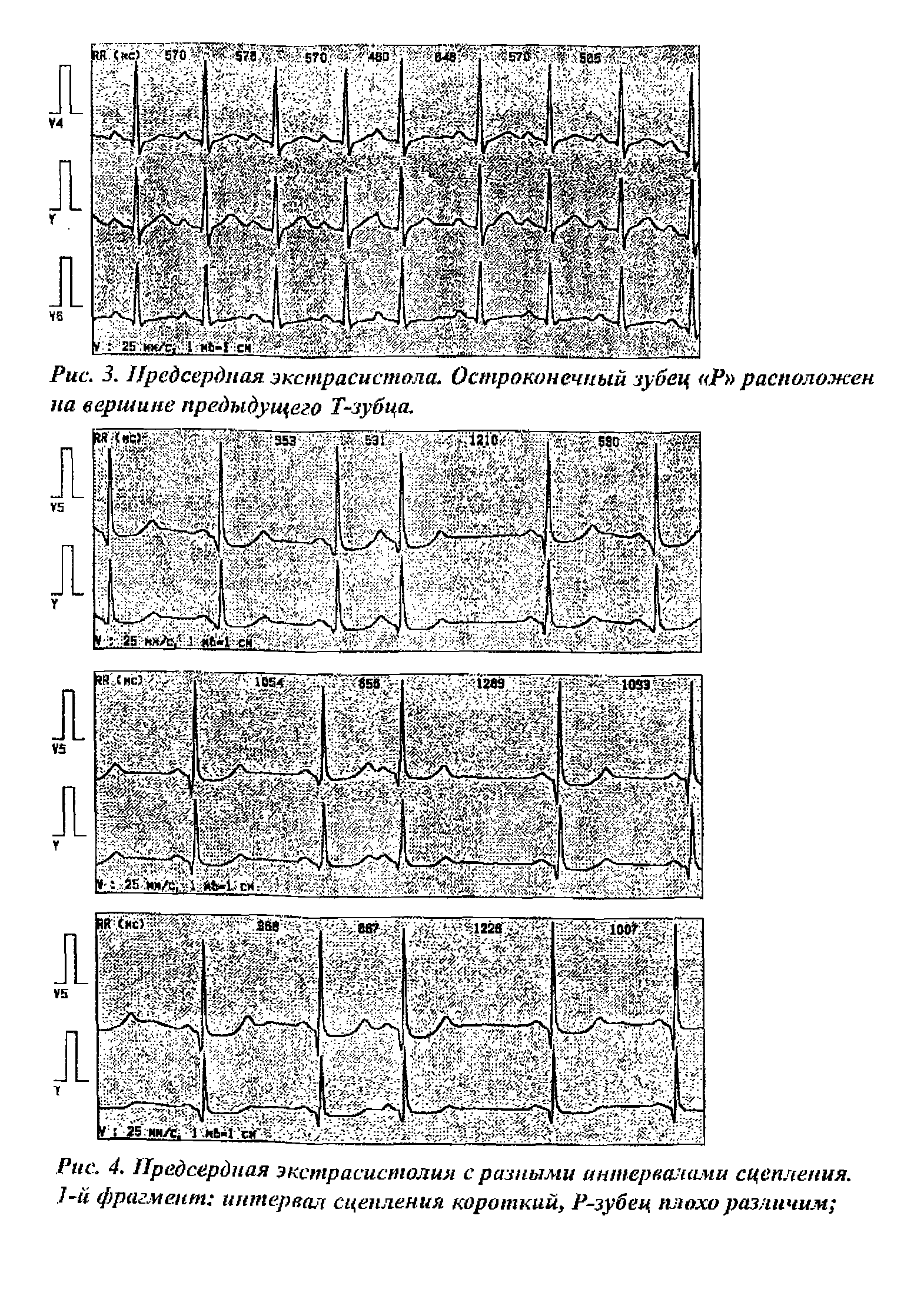 Рис. 4. Предсердная экстрасистолия с разными интервалами сцепления. ] й фрагмент интервал сцепления короткий, Р-зубец плохо различим ...
