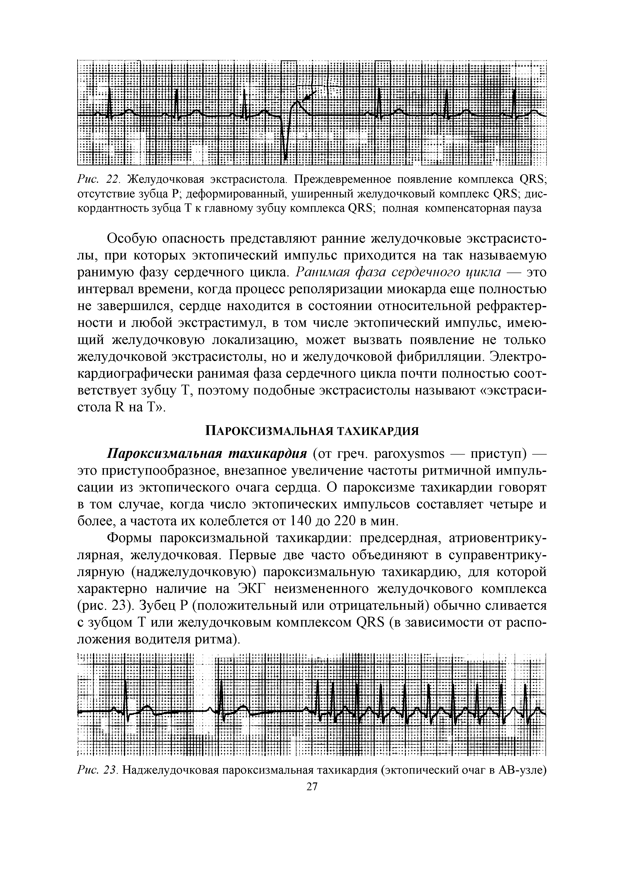 Рис. 23. Наджелудочковая пароксизмальная тахикардия (эктопический очаг в АВ-узле) 27...