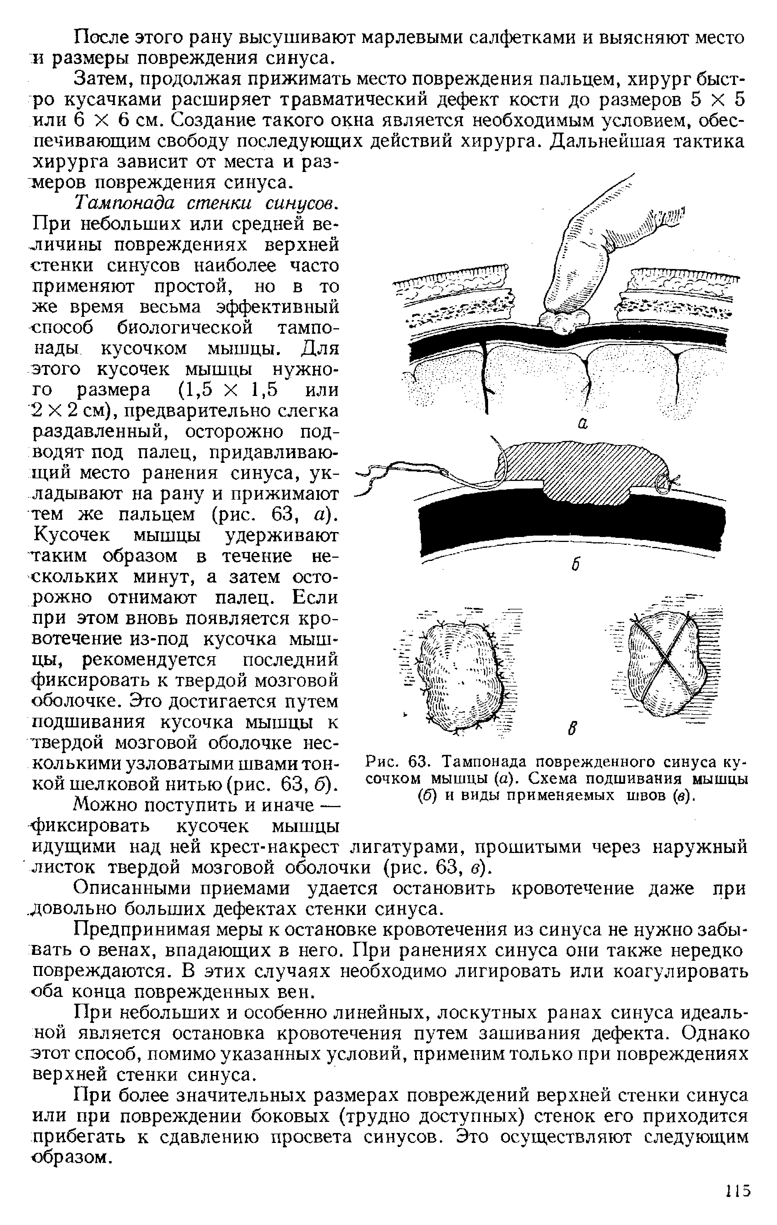 Рис. 63. Тампонада поврежденного синуса кусочком мышцы (а). Схема подшивания мышцы (б) и виды применяемых швов (в).