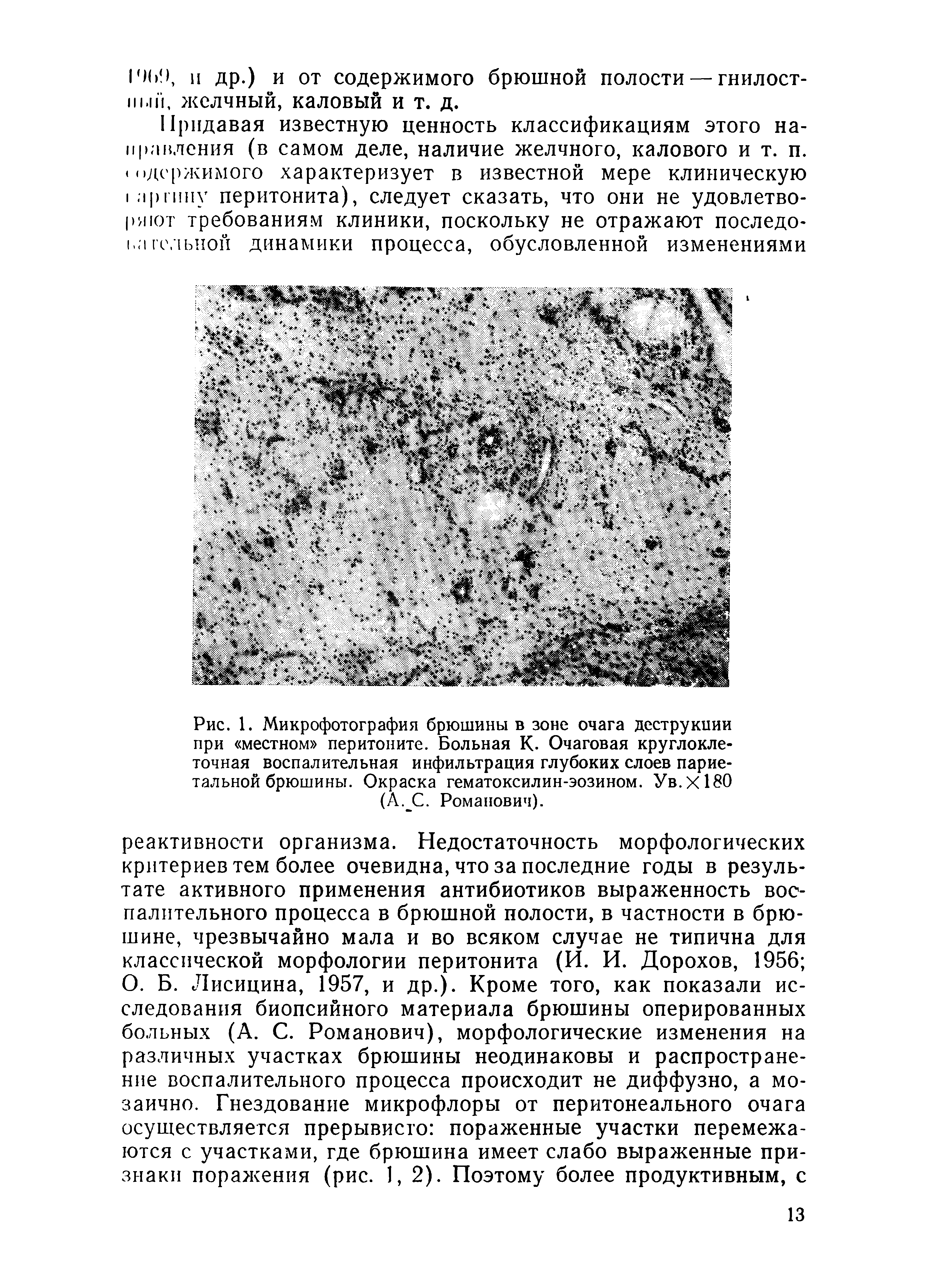 Рис. 1. Микрофотография брюшины в зоне очага деструкции при местном перитоните. Больная К. Очаговая круглоклеточная воспалительная инфильтрация глубоких слоев париетальной брюшины. Окраска гематоксилин-эозином. Ув.Х180 (А. С. Романович).