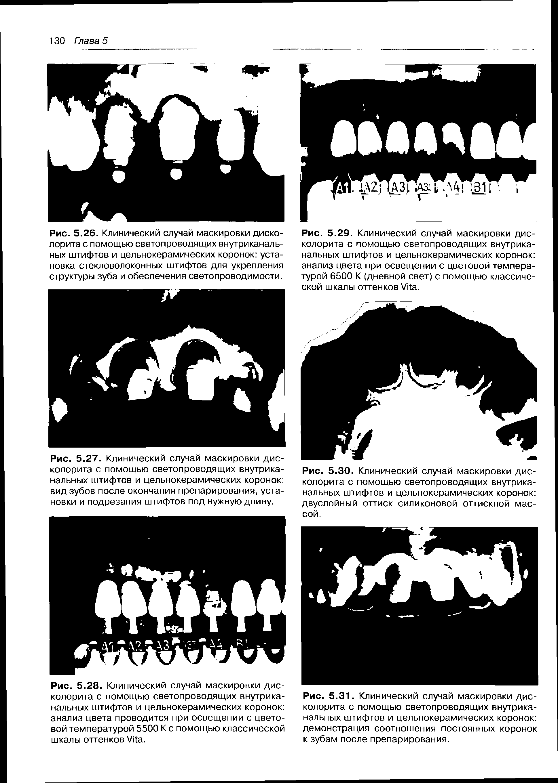 Рис. 5.29. Клинический случай маскировки дис-колорита с помощью светопроводящих внутриканальных штифтов и цельнокерамических коронок анализ цвета при освещении с цветовой температурой 6500 К (дневной свет) с помощью классической шкалы оттенков V .