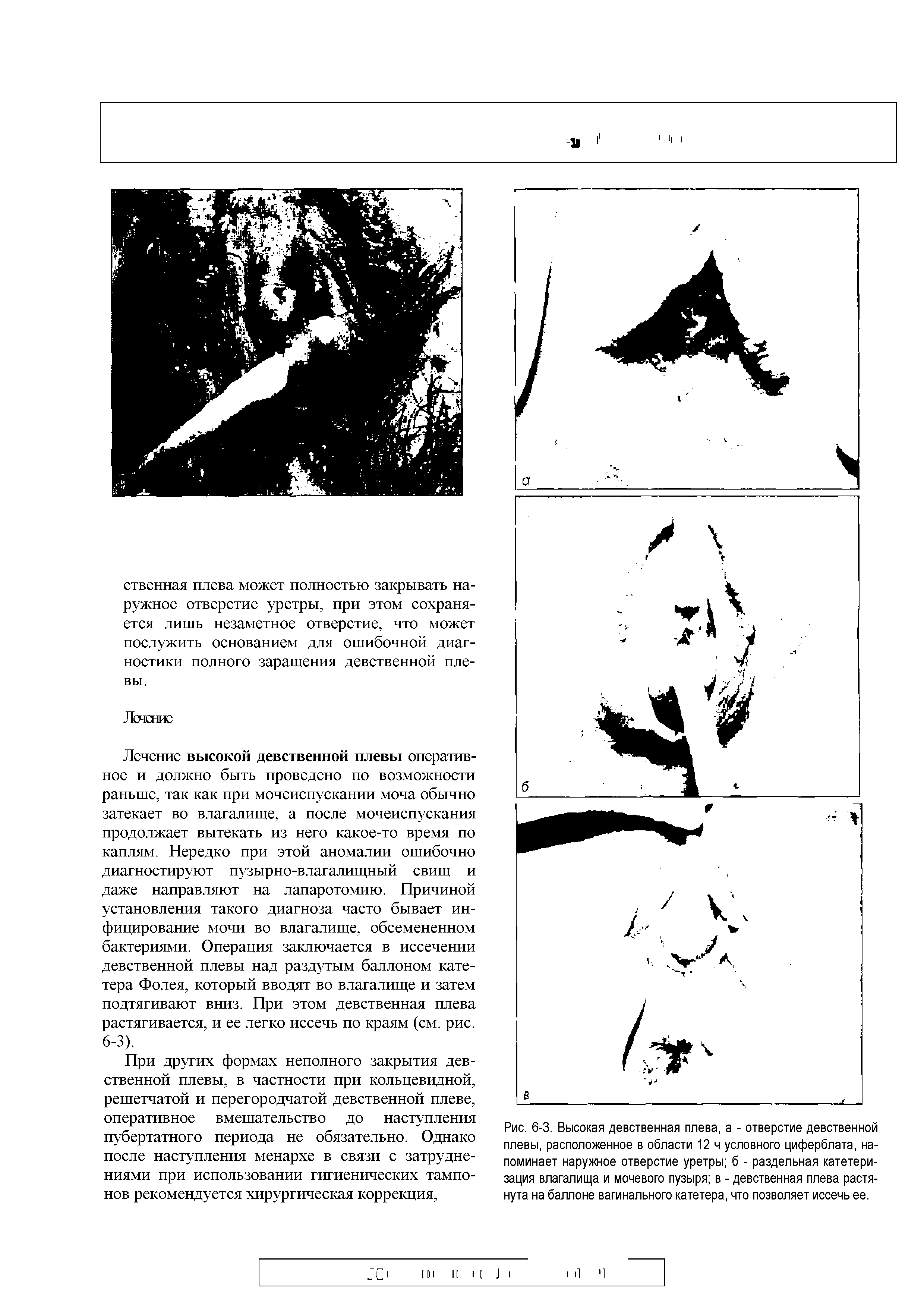 Рис. 6-3. Высокая девственная плева, а - отверстие девственной плевы, расположенное в области 12 ч условного циферблата, напоминает наружное отверстие уретры б - раздельная катетеризация влагалища и мочевого пузыря в - девственная плева растянута на баллоне вагинального катетера, что позволяет иссечь ее.