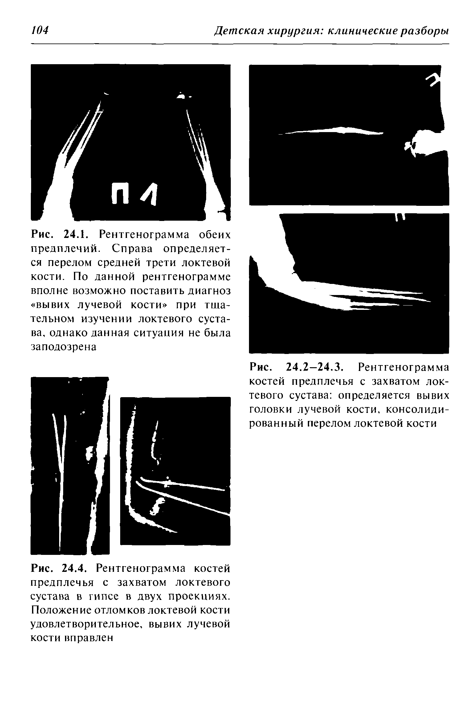 Рис. 24.2—24.3. Рентгенограмма костей предплечья с захватом локтевого сустава определяется вывих головки лучевой кости, консолидированный перелом локтевой кости...
