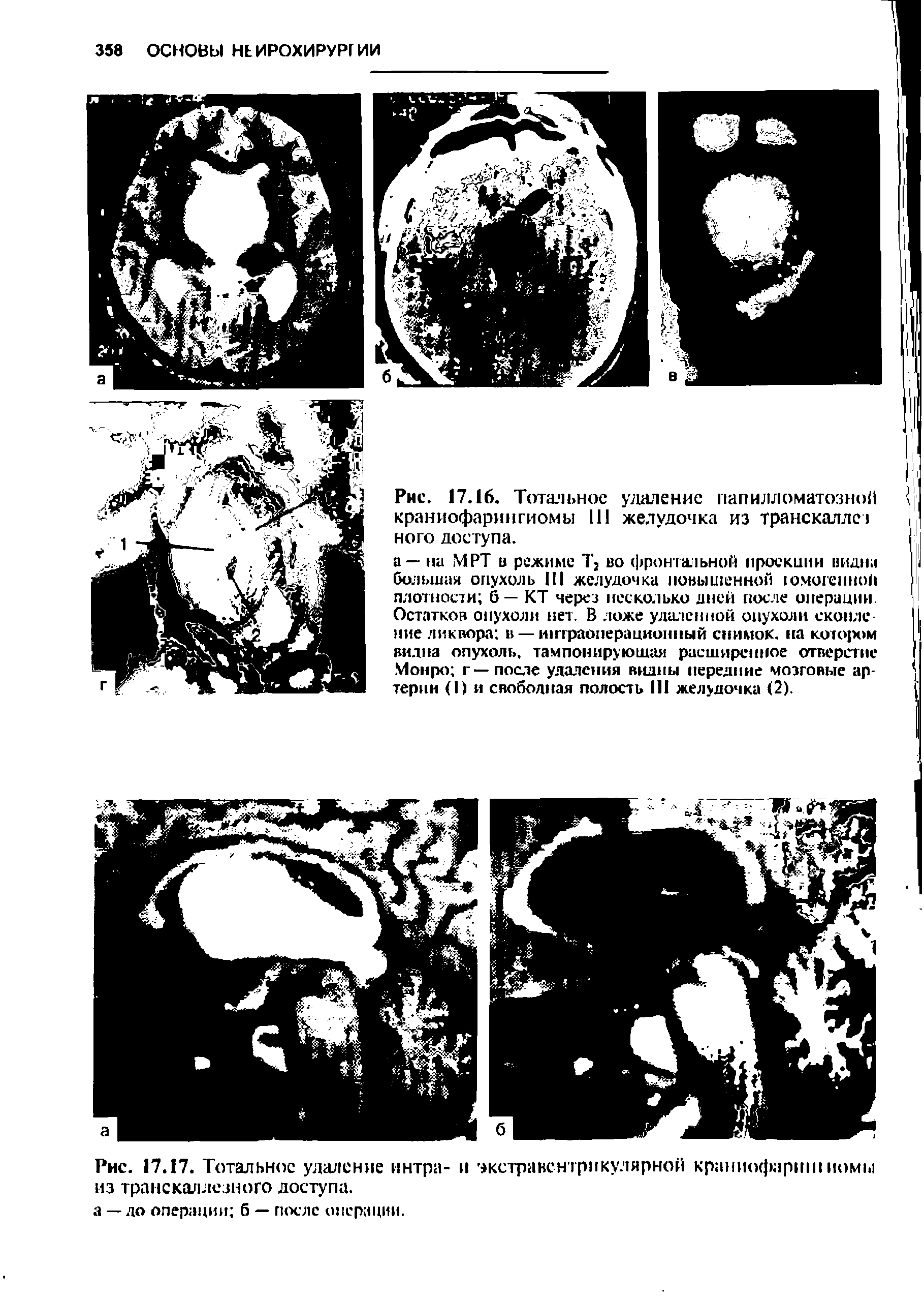 Рис. 17.17. Тотальное удаление интра- и экстравентрикулярной краниофариш иомы из транскаллезного доступа.