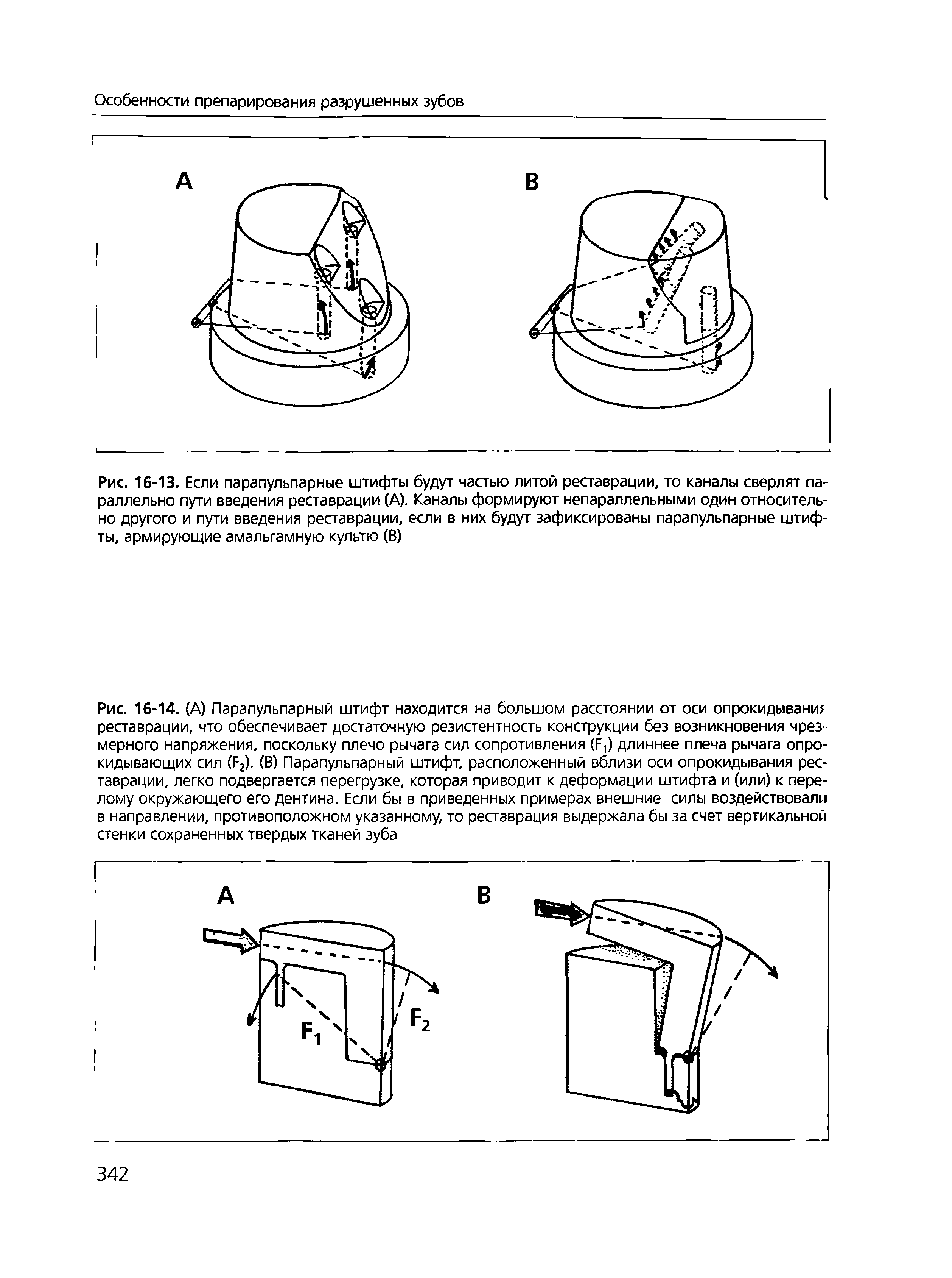Рис. 16-13. Если парапульпарные штифты будут частью литой реставрации, то каналы сверлят параллельно пути введения реставрации (А). Каналы формируют непараллельными один относительно другого и пути введения реставрации, если в них будут зафиксированы парапульпарные штифты, армирующие амальгамную культю (В)...