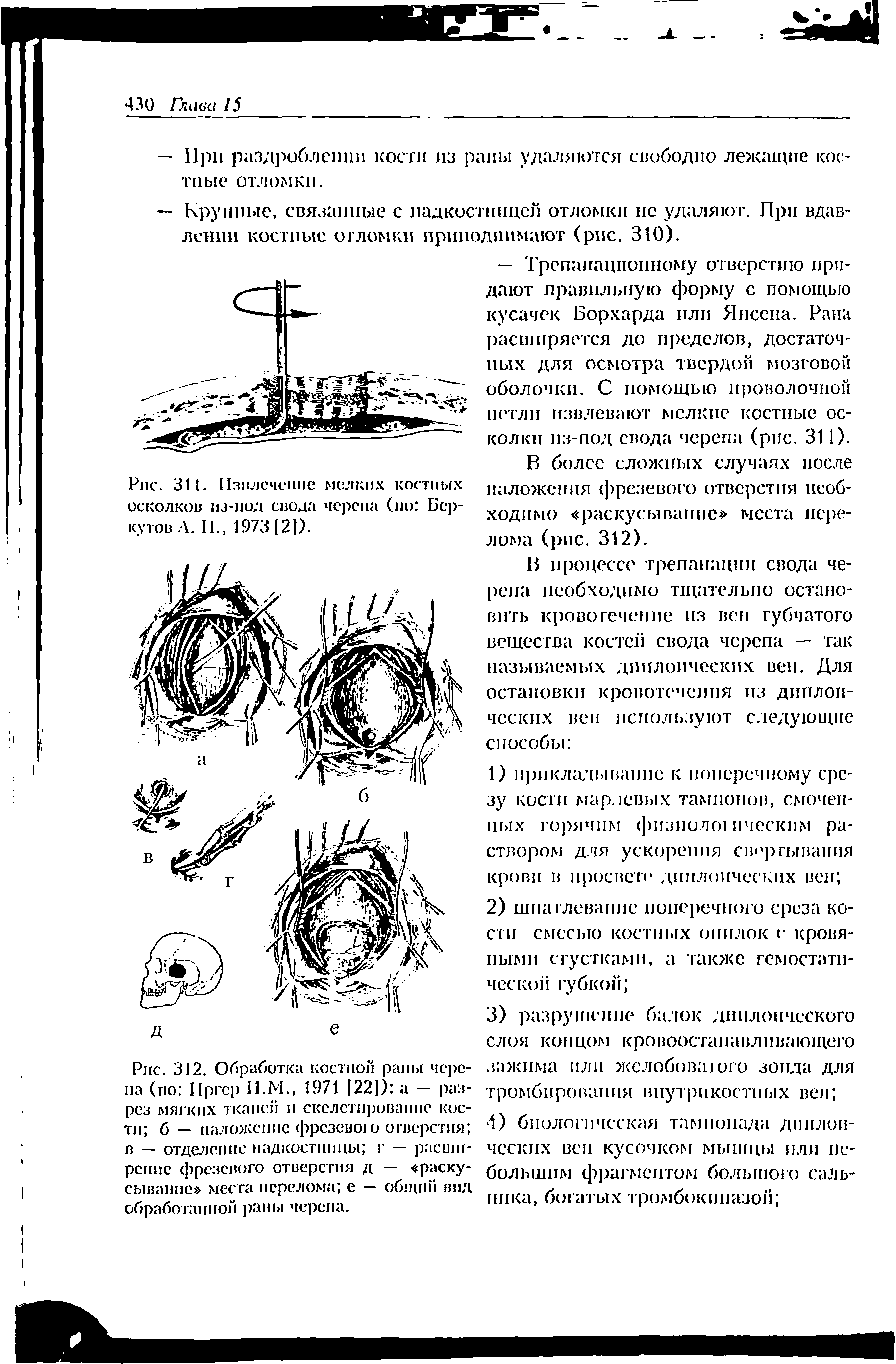 Рис. 312. Обработка костной раны черепа (по Пргср Н.М., 1971 [22]) а — разрез мягких тканей и скелетирование кости б — наложение фрезево о отверстия в — отделение надкостницы г — расширение фрезевого отверстия д — раскусывание места перелома е — общий вид обработанной раны черепа.