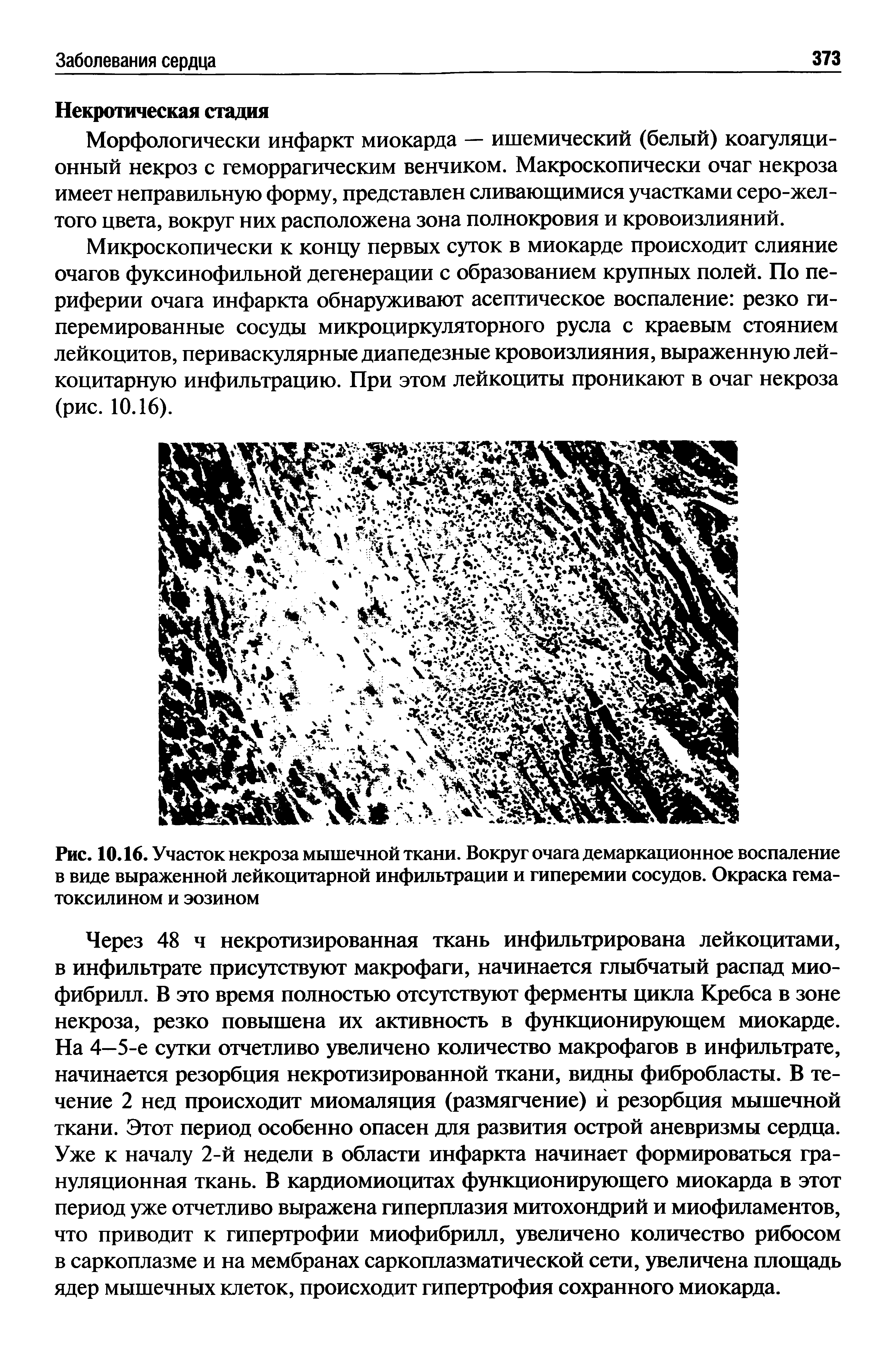 Рис. 10.16. Участок некроза мышечной ткани. Вокруг очага демаркационное воспаление в виде выраженной лейкоцитарной инфильтрации и гиперемии сосудов. Окраска гематоксилином и эозином...