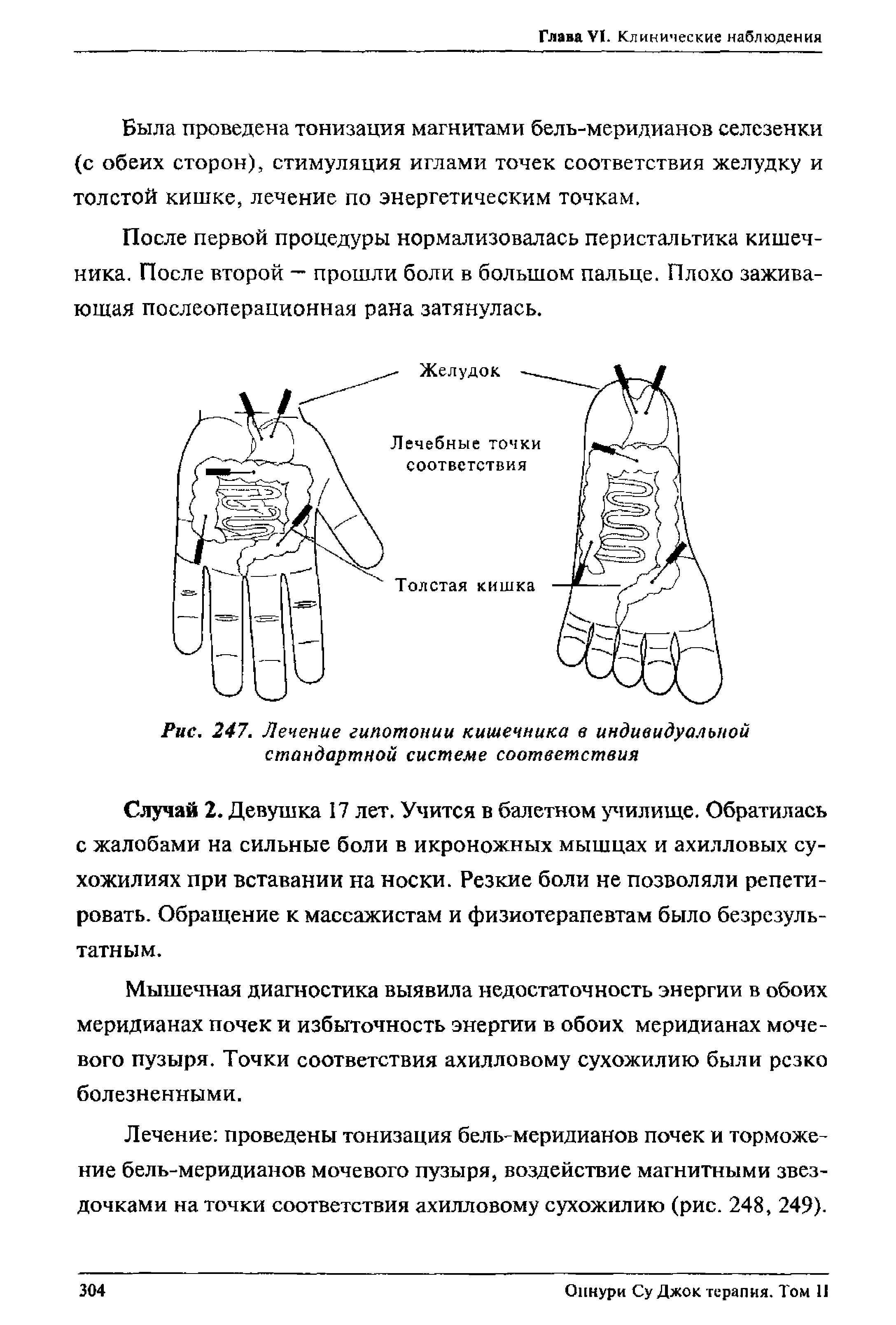Рис. 247. Лечение гипотонии кишечника в индивидуальной стандартной системе соответствия...