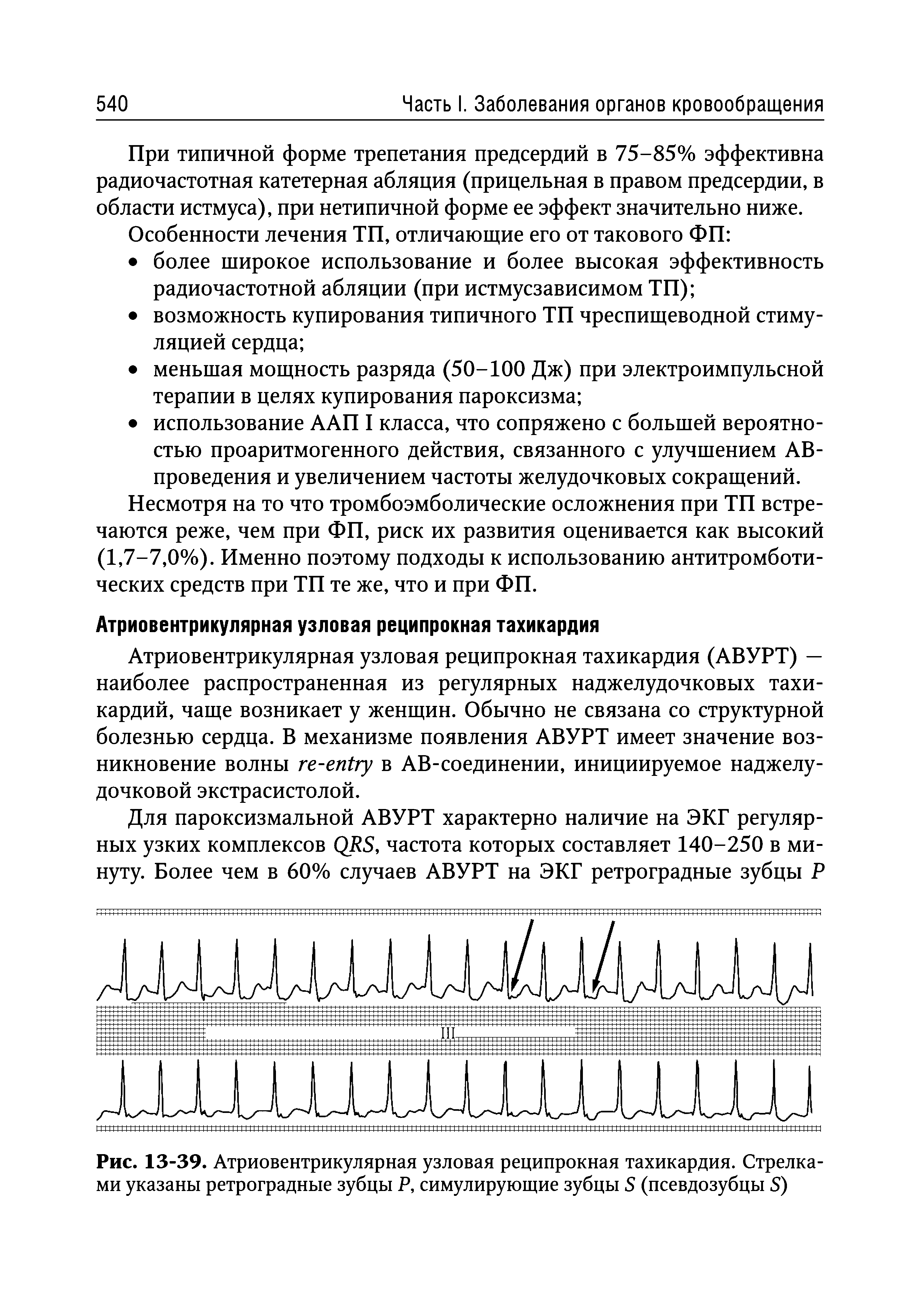 Рис. 13-39. Атриовентрикулярная узловая реципрокная тахикардия. Стрелками указаны ретроградные зубцы Р, симулирующие зубцы 5 (псевдозубцы 5)...