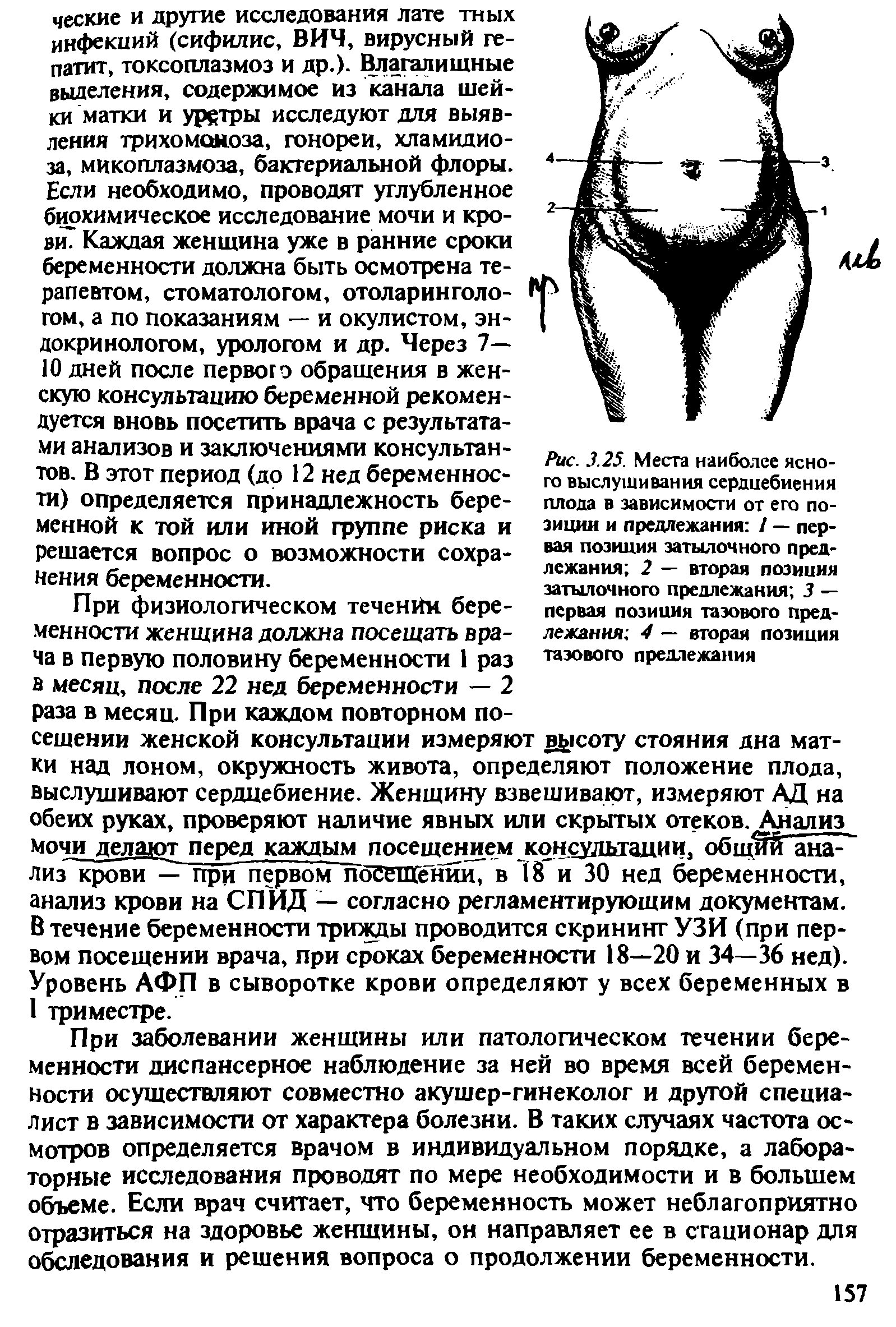 Рис. 3.25. Места наиболее ясного выслушивания сердцебиения плода в зависимости от его позиции и предлежания / — первая позиция затылочного предлежания 2 — вторая позиция затылочного предлежания 3 — первая позиция тазового предлежания 4 — вторая позиция тазового предлежания...