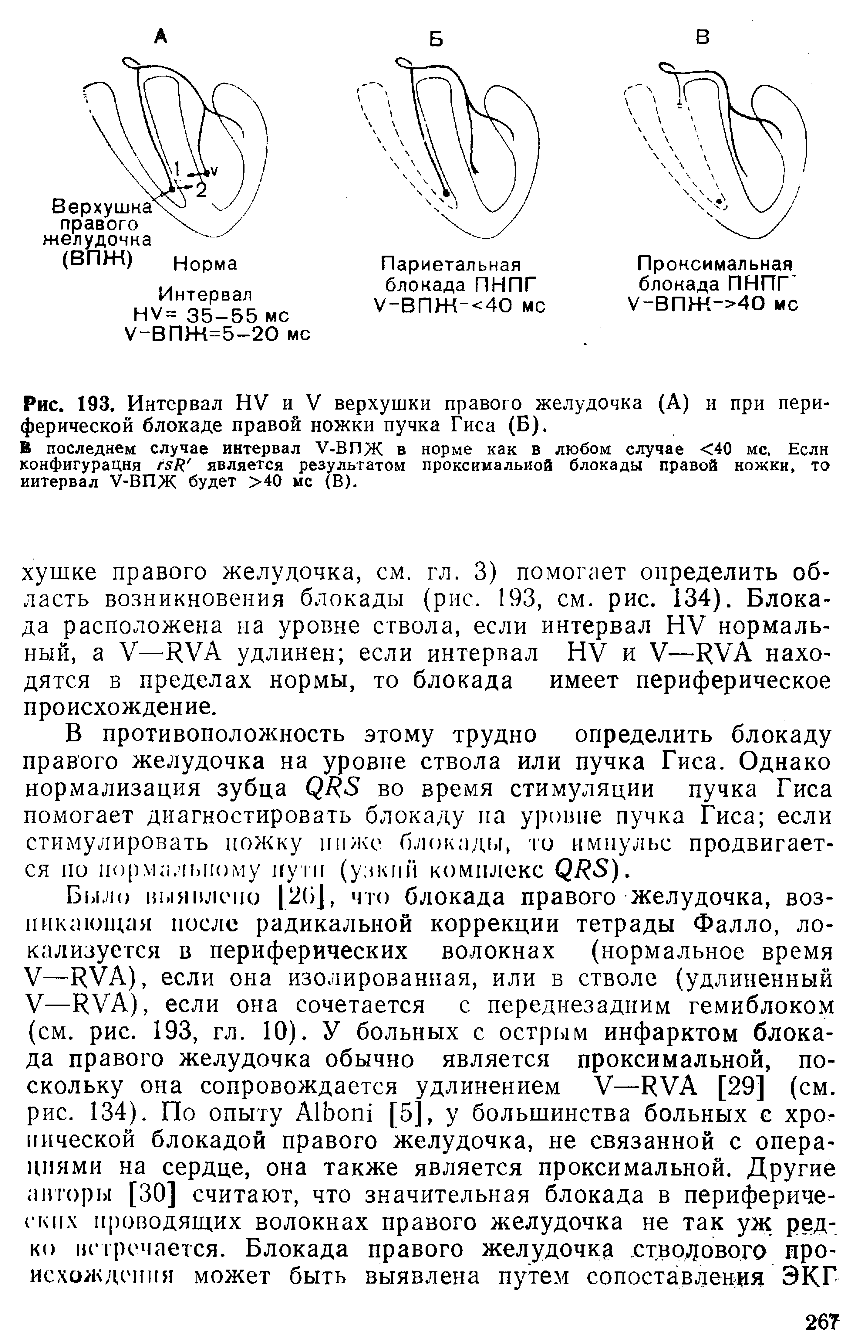 Рис. 193. Интервал НУ и V верхушки правого желудочка (А) и при периферической блокаде правой ножки пучка Гиса (Б).