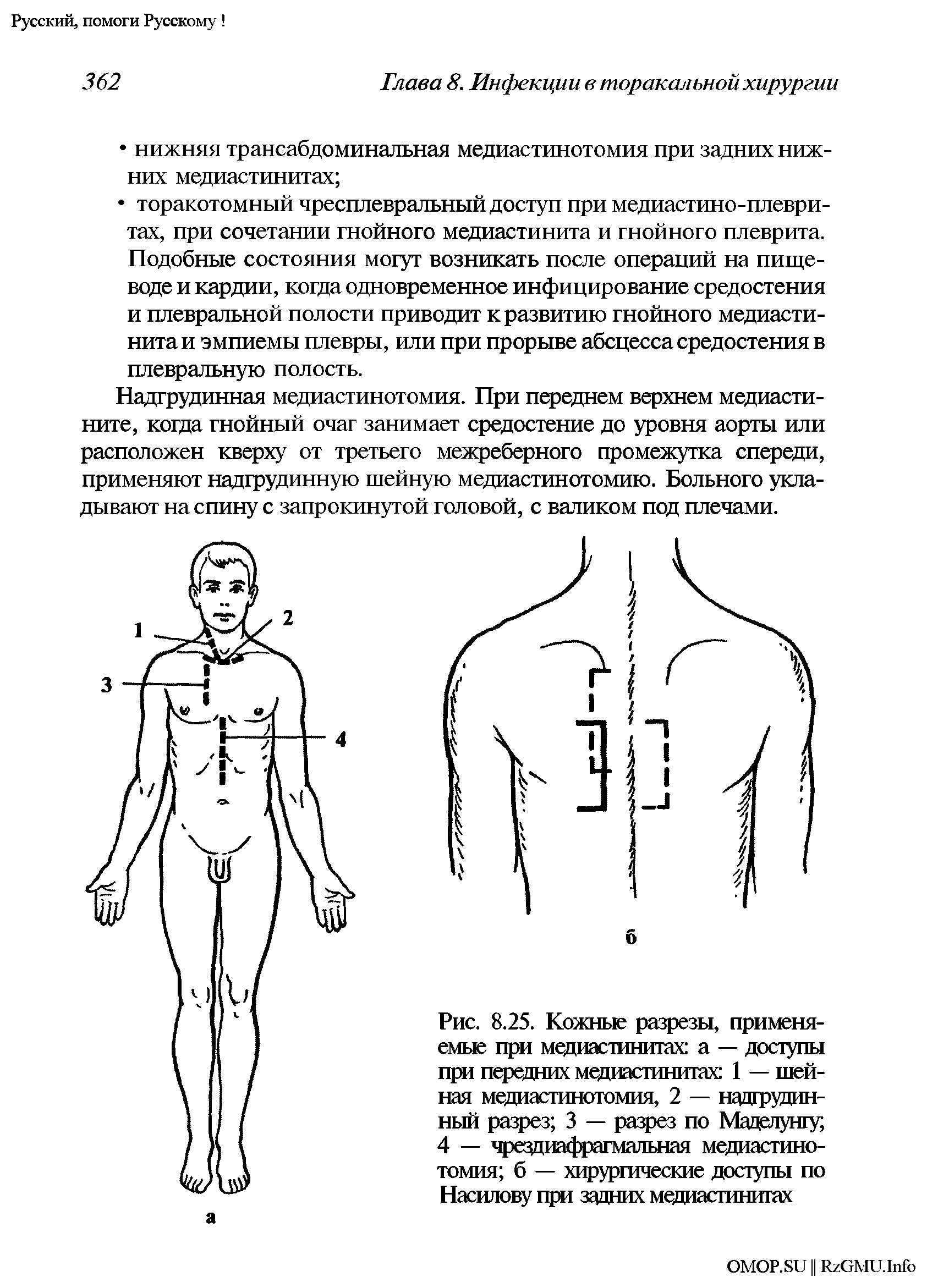 Рис. 8.25. Кожные разрезы, применяемые при медиастинитах а — доступы при передних медиастинитах 1 — шейная медиастинотомия, 2 — надгрудинный разрез 3 — разрез по Маделунгу, 4 — чрездиафрагмальная медиастинотомия б — хирургические доступы по Насилову при задних медиастинитах...