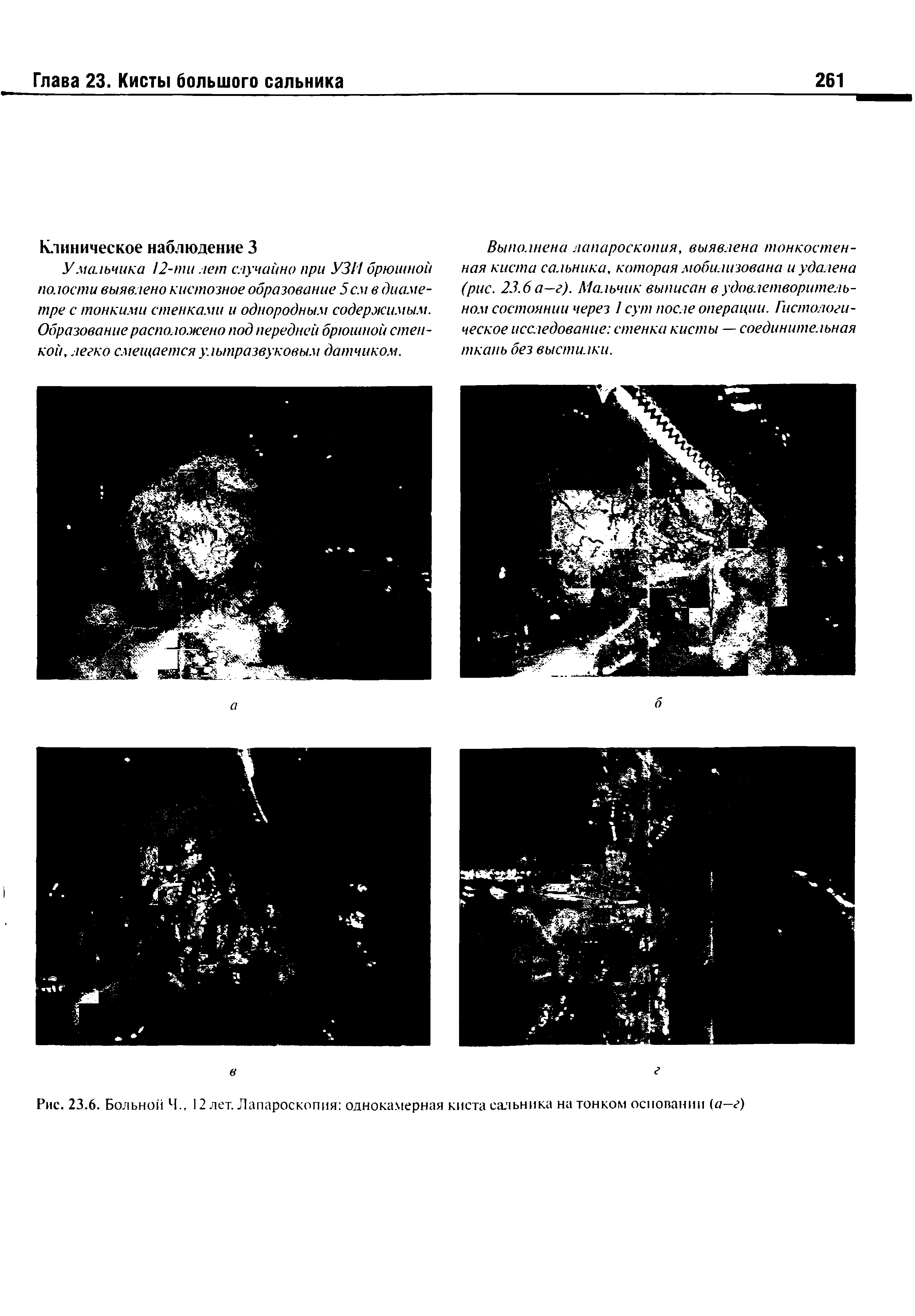 Рис. 23.6. Больной Ч., 12 лет. Лапароскопия однокамерная киста сальника на тонком основании (а—г)...