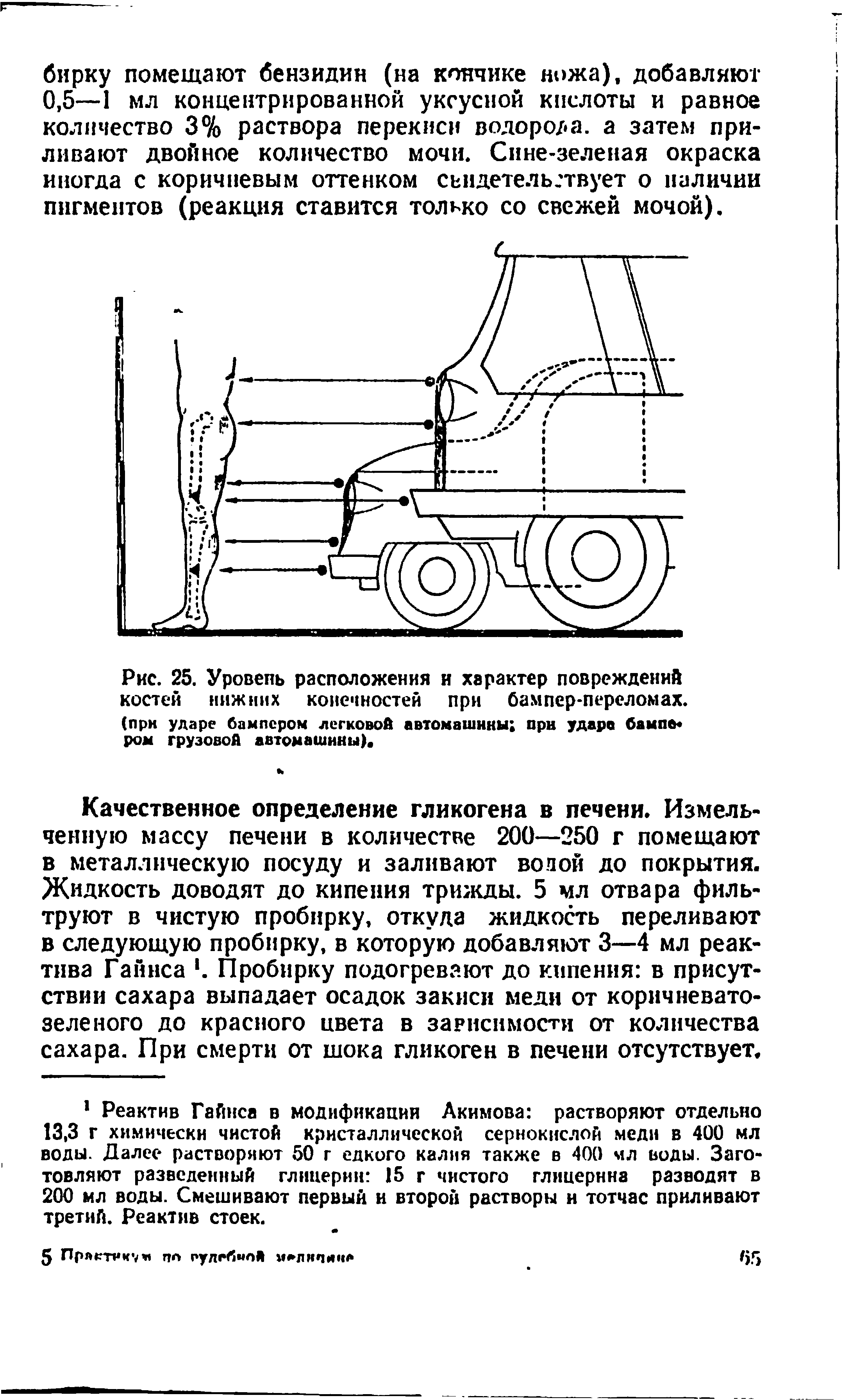 Рис. 25. Уровень расположения и характер повреждений костей нижних конечностей при бампер-переломах. (при ударе бампером легковой автомашины при удара бампа ром грузовой автомашины).