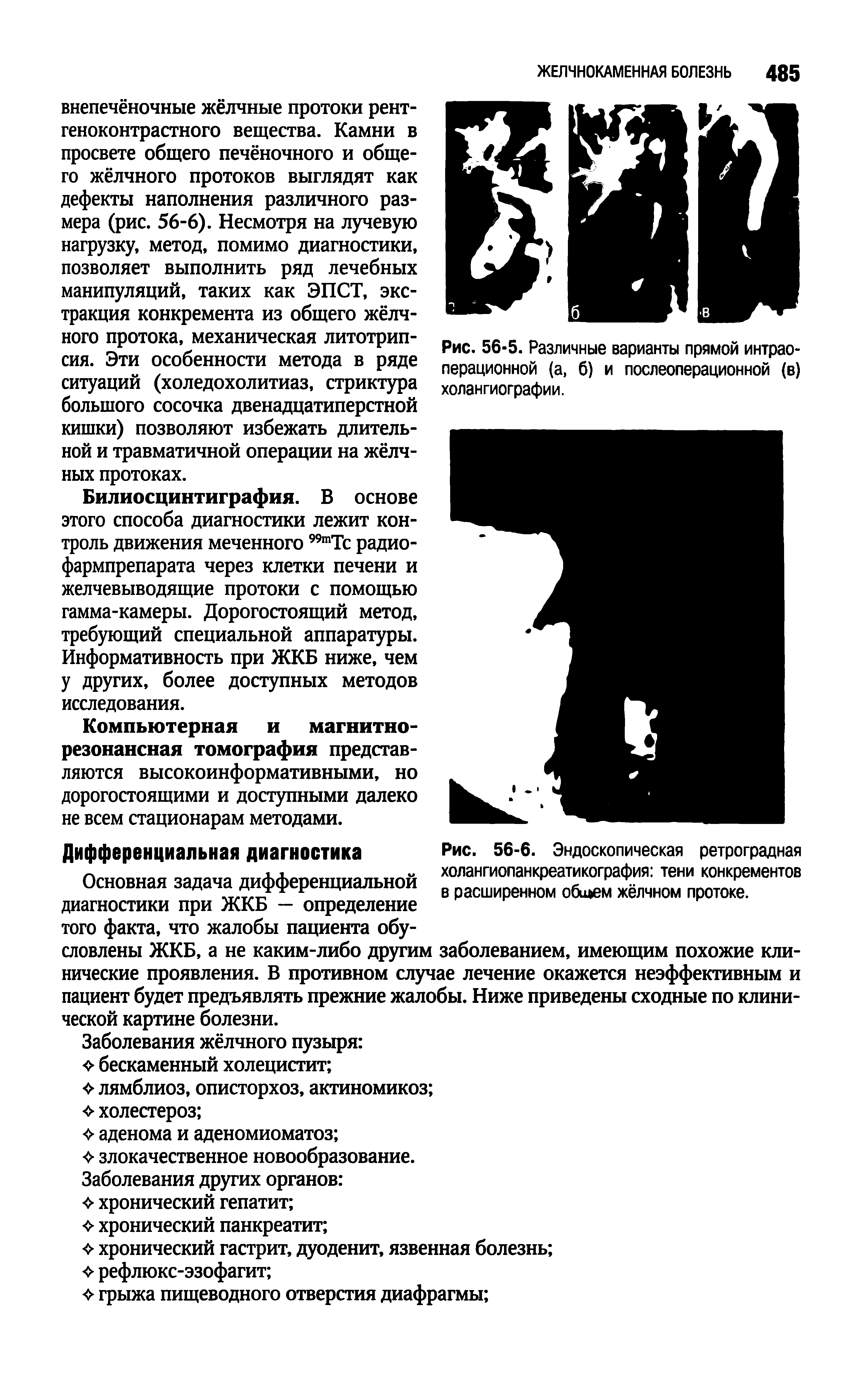 Рис. 56-6. Эндоскопическая ретроградная холангиопанкреатикография тени конкрементов в расширенном оби ем жёлчном протоке.