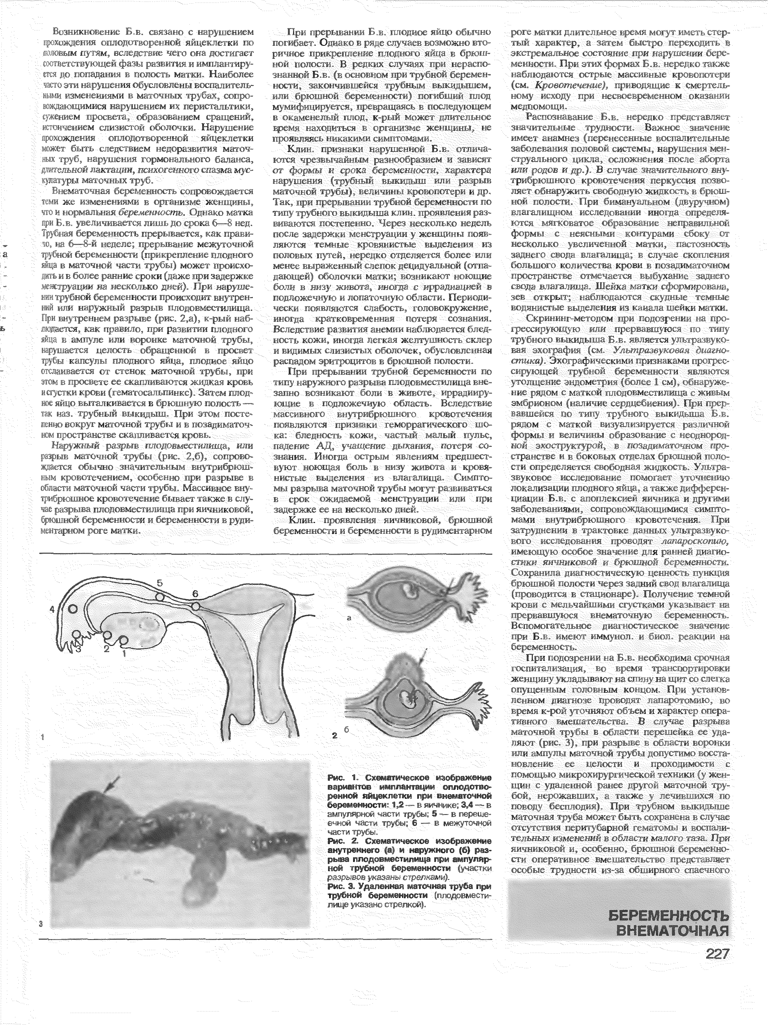 Рис. 1. Схематическое изображение вариантов имплантации оплодотворенной яйцеклетки при внематочной беременности 1,2 — в яичнике 3,4 — в ампулярной части трубы 5 — в перешеечной части трубы 6 — в межуточной частитрубы.