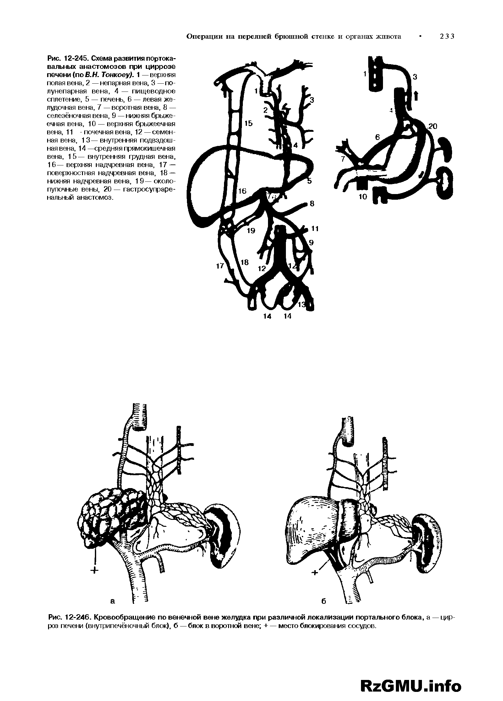 Рис. 12-246. Кровообращение по венечной вене желудка при различной локализации портального блока, а — цирроз печени (внутрипечёночный блок), б — блок в воротной вене + — место блокирования сосудов.