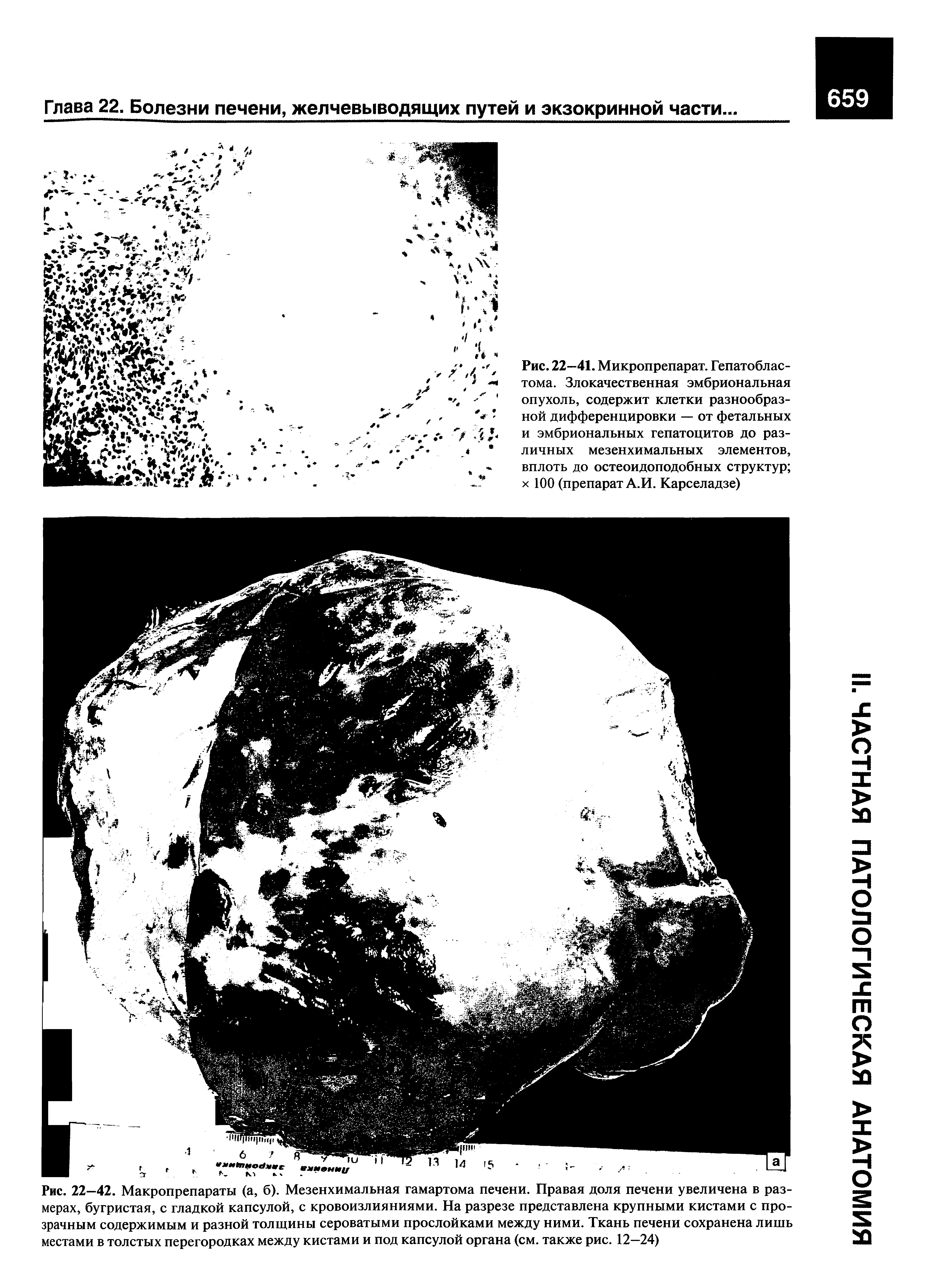 Рис. 22—41. Микропрепарат. Гепатобластома. Злокачественная эмбриональная опухоль, содержит клетки разнообразной дифференцировки — от фетальных и эмбриональных гепатоцитов до различных мезенхимальных элементов, вплоть до остеоидоподобных структур х 100 (препарат А.И. Карселадзе)...