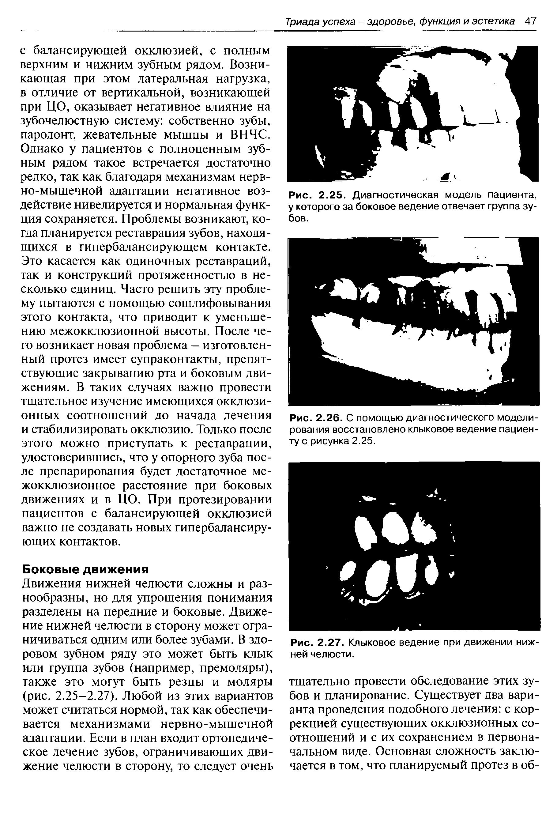 Рис. 2.26. С помощью диагностического моделирования восстановлено клыковое ведение пациенту с рисунка 2.25.