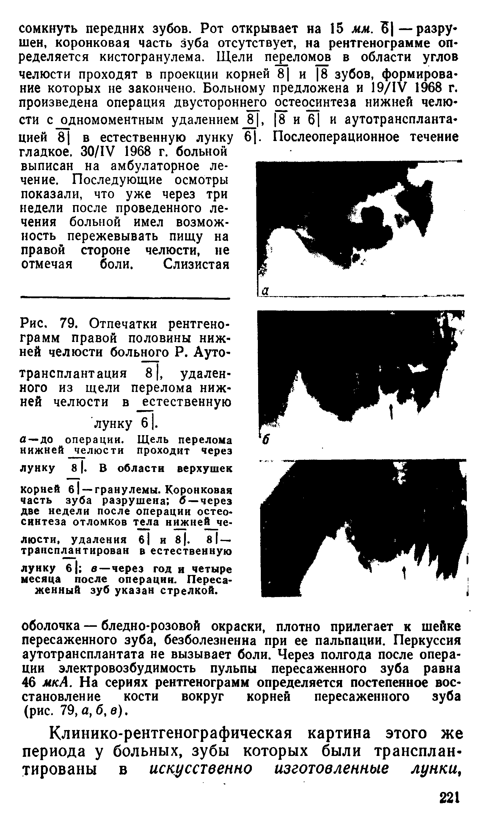 Рис. 79. Отпечатки рентгенограмм правой половины нижней челюсти больного Р. Аутотрансплантация 81, удаленного из щели перелома нижней челюсти в естественную лунку б. ...