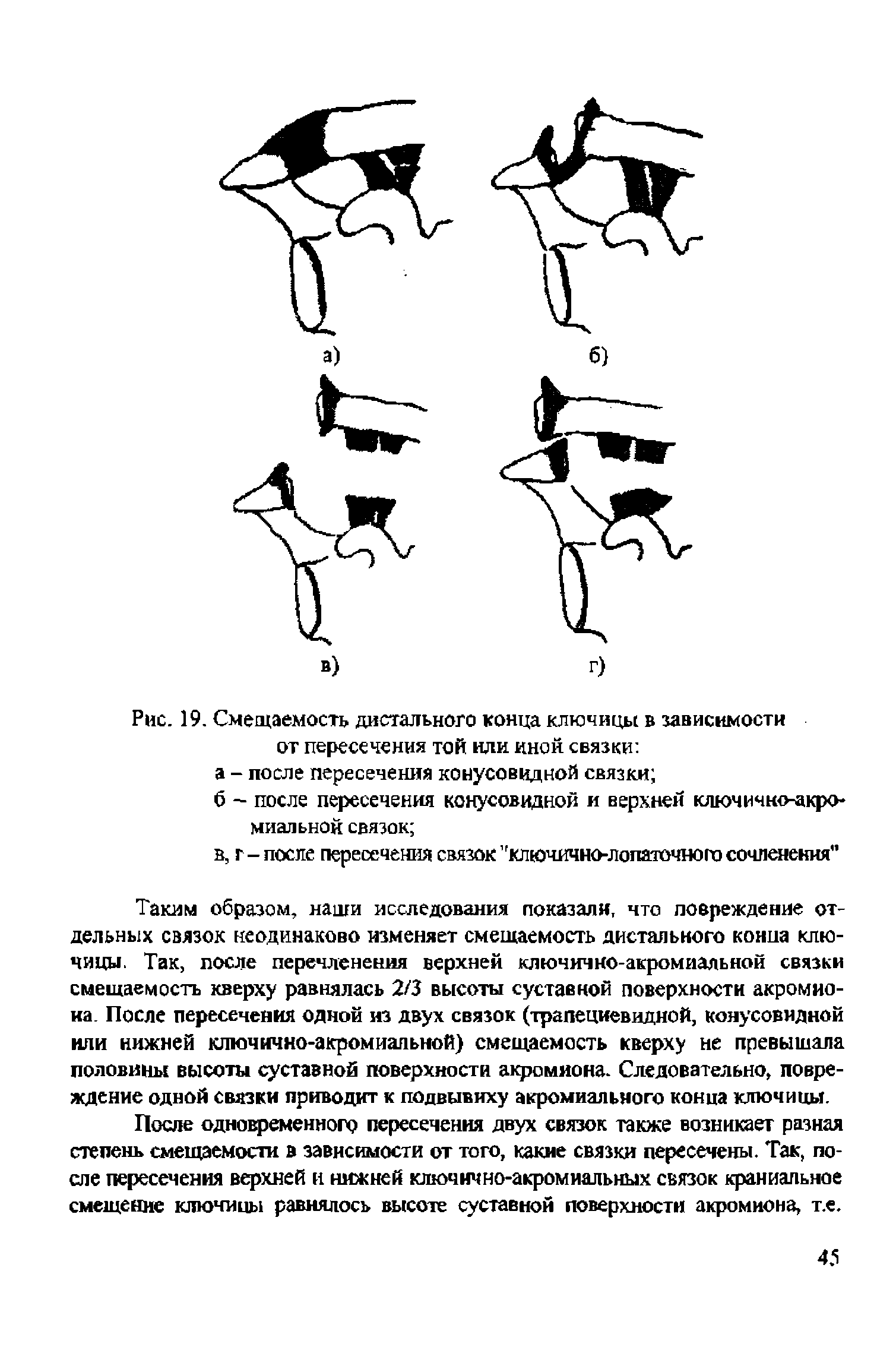 Рис. 19. Сменяемость дистального конца ключицы в зависимости от пересечения той или иной связки а - после пересечения конусовидной связки ...